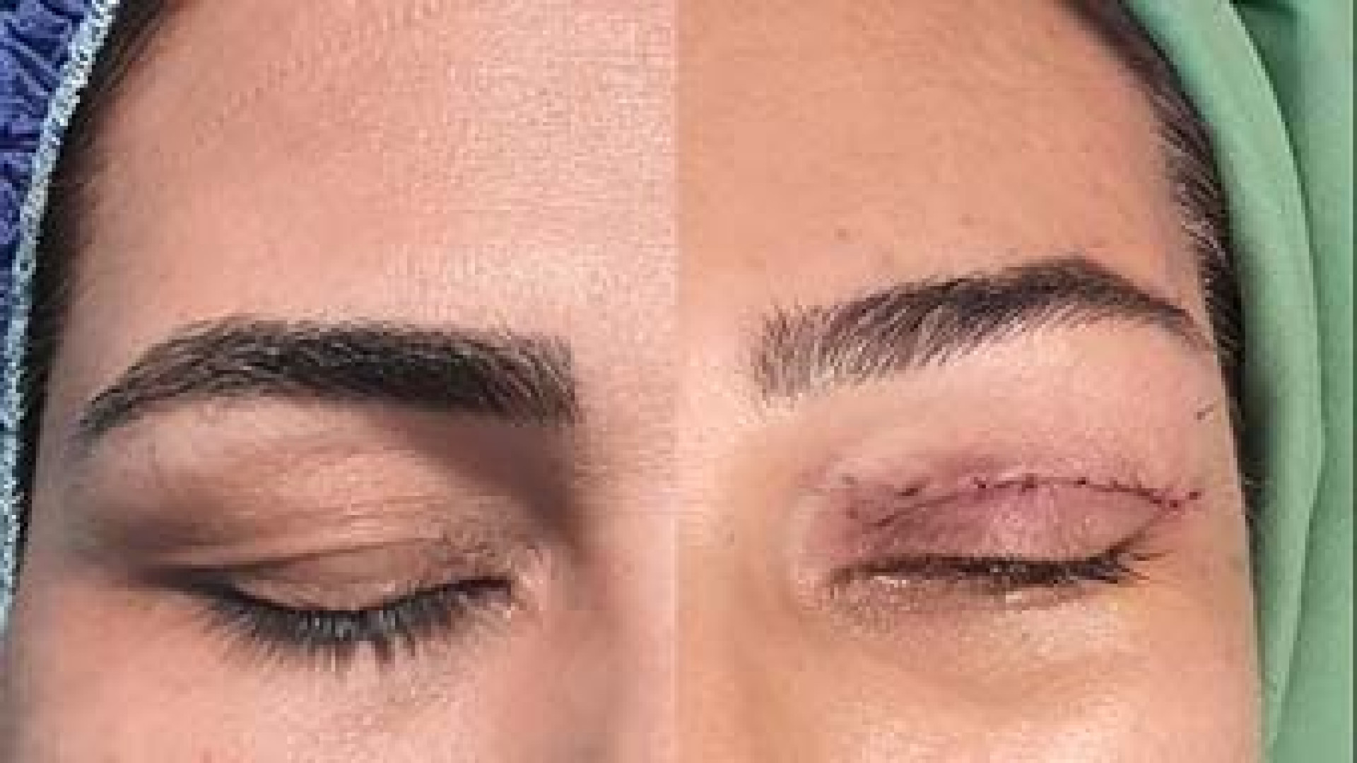لیفت آندوسکوپی پیشانی،شقیقه و ابرو همراه با بلفاروپلاستی کاشت ریش