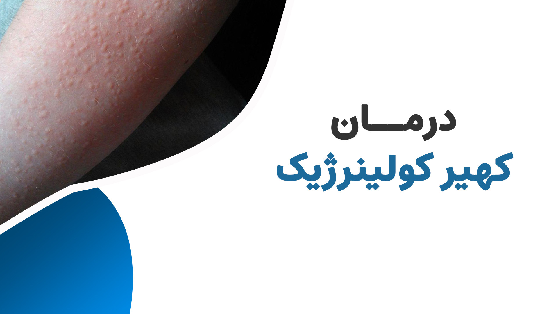 درمان کهیر کولینرژیک جعفر خوشخواب