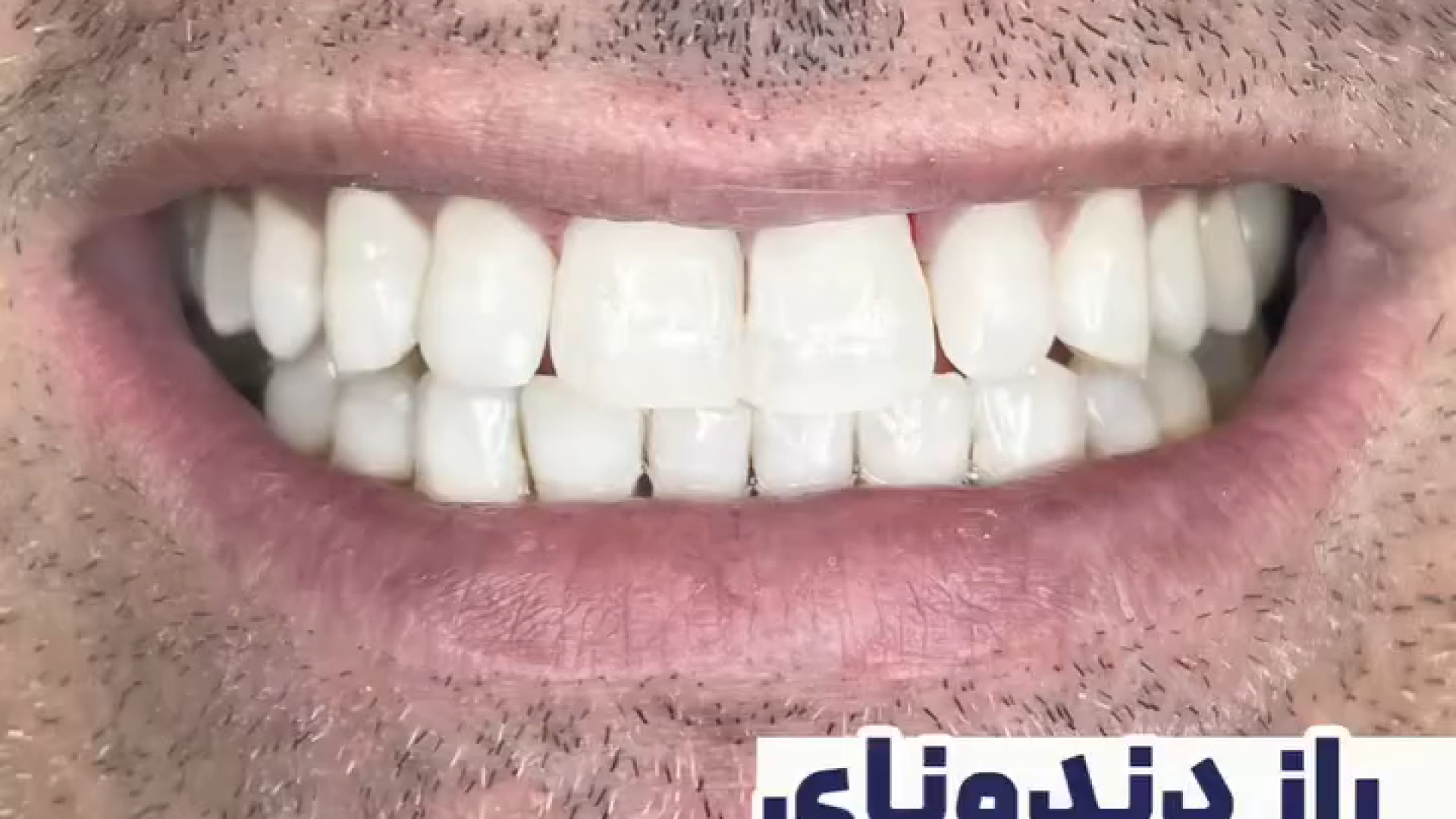 راز سفیدی دندان ها با بلیچینگ | دکتر هاشمی RF Test