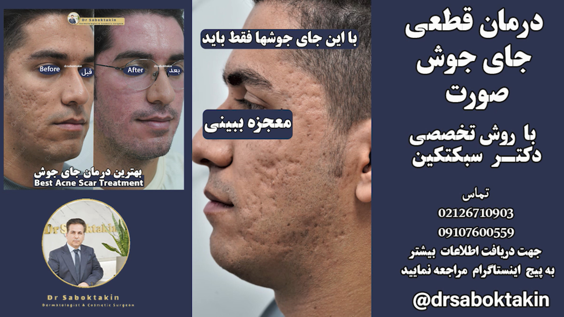 بهترین درمان جای جوش - درمان قطعی اسکار آکنه (لیزر جای جوش) برداشتن خال