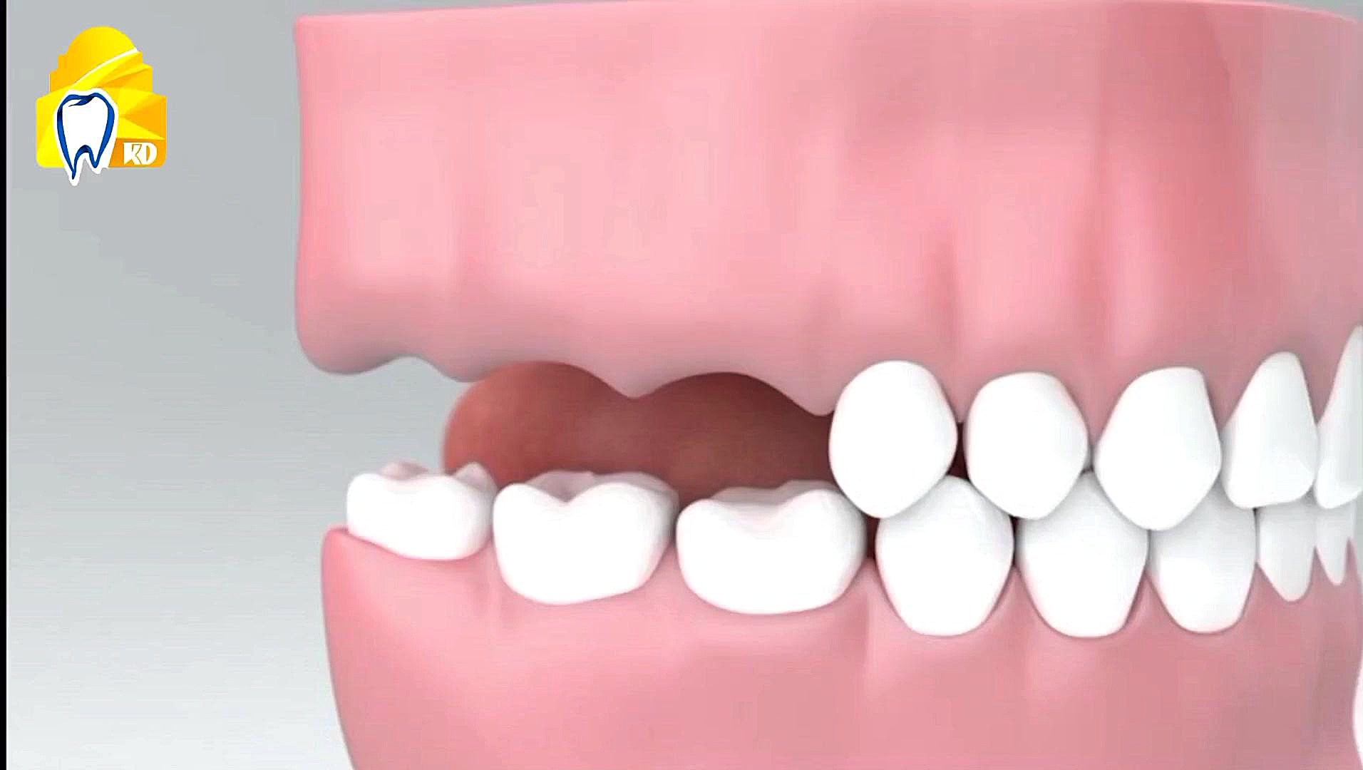 سینوس لیفت باز به روش پینجره کلینیک دندانپزشکی کارمادنت