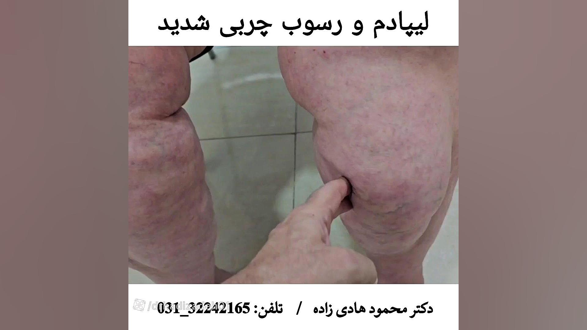 لیپادم و رسوب چربی شدید | دکتر محمود هادی زاده مریل استریپ