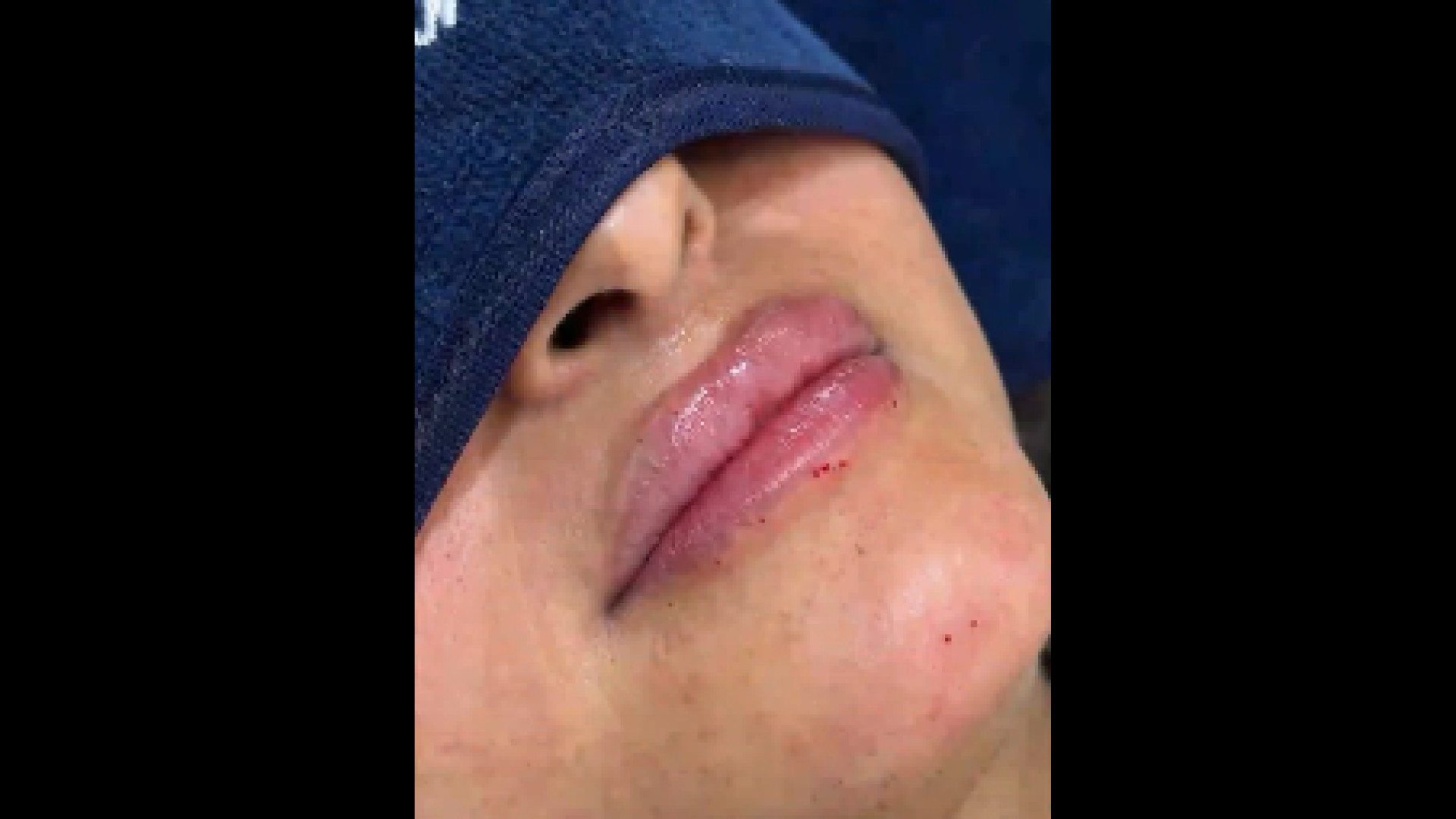 نمونه کار فیلر لب در کلینیک دکتر هدی دکتر هدی عین اللهی