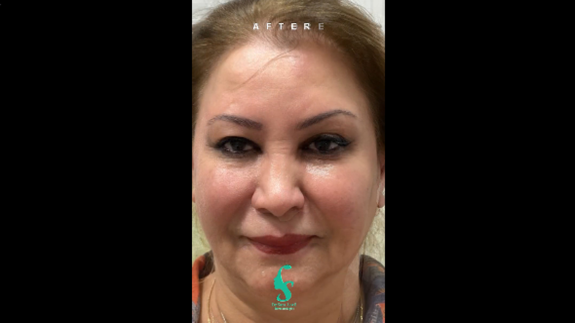 تزریق بوتاکس و فیلر پیشانی دکتر سار ا لطفی