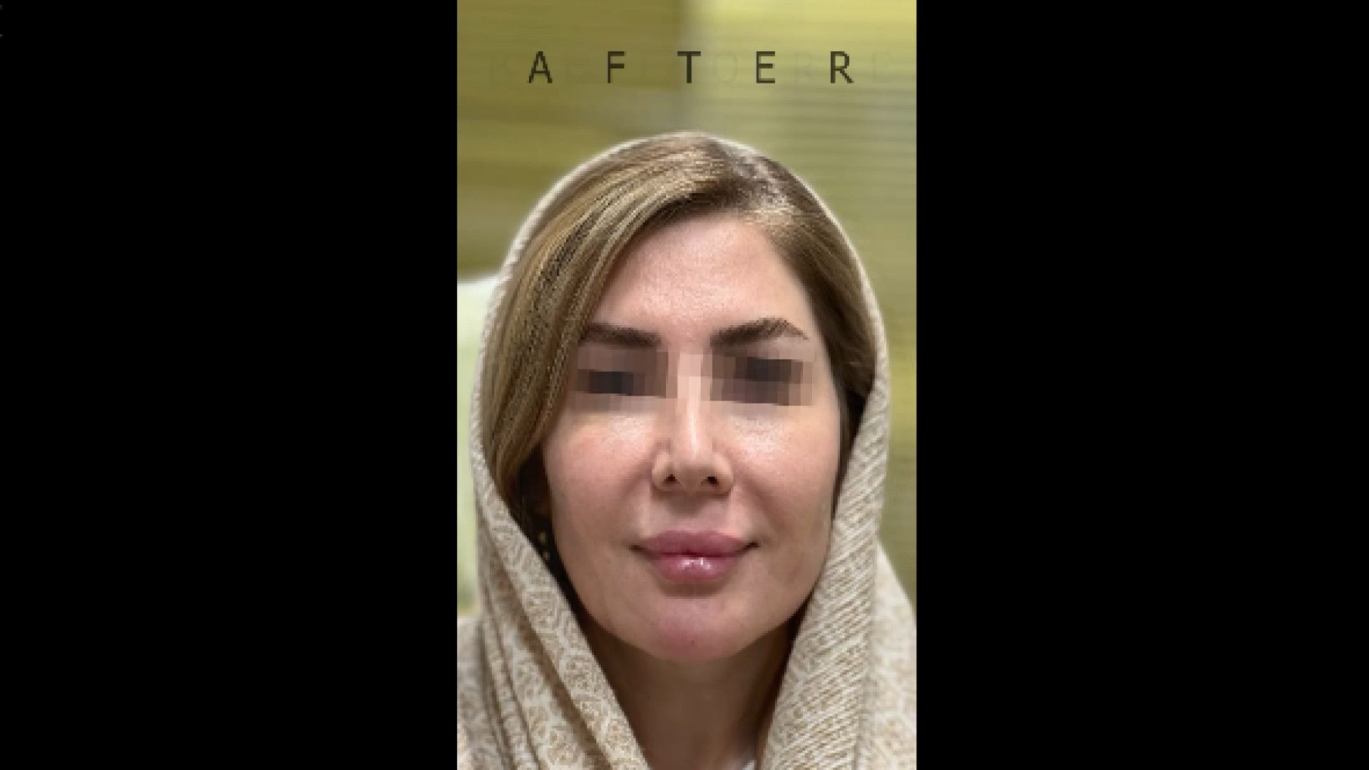 تزریق فیلر کل صورت دکتر سار ا لطفی