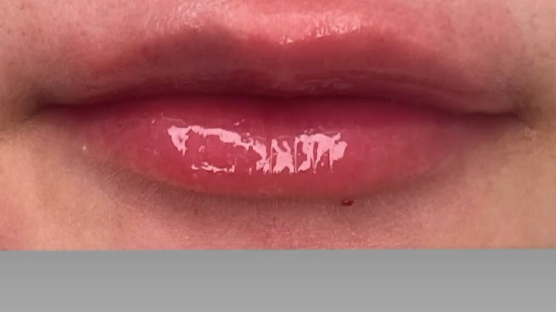 نمونه کار فیلر لب دکتر سار ا لطفی