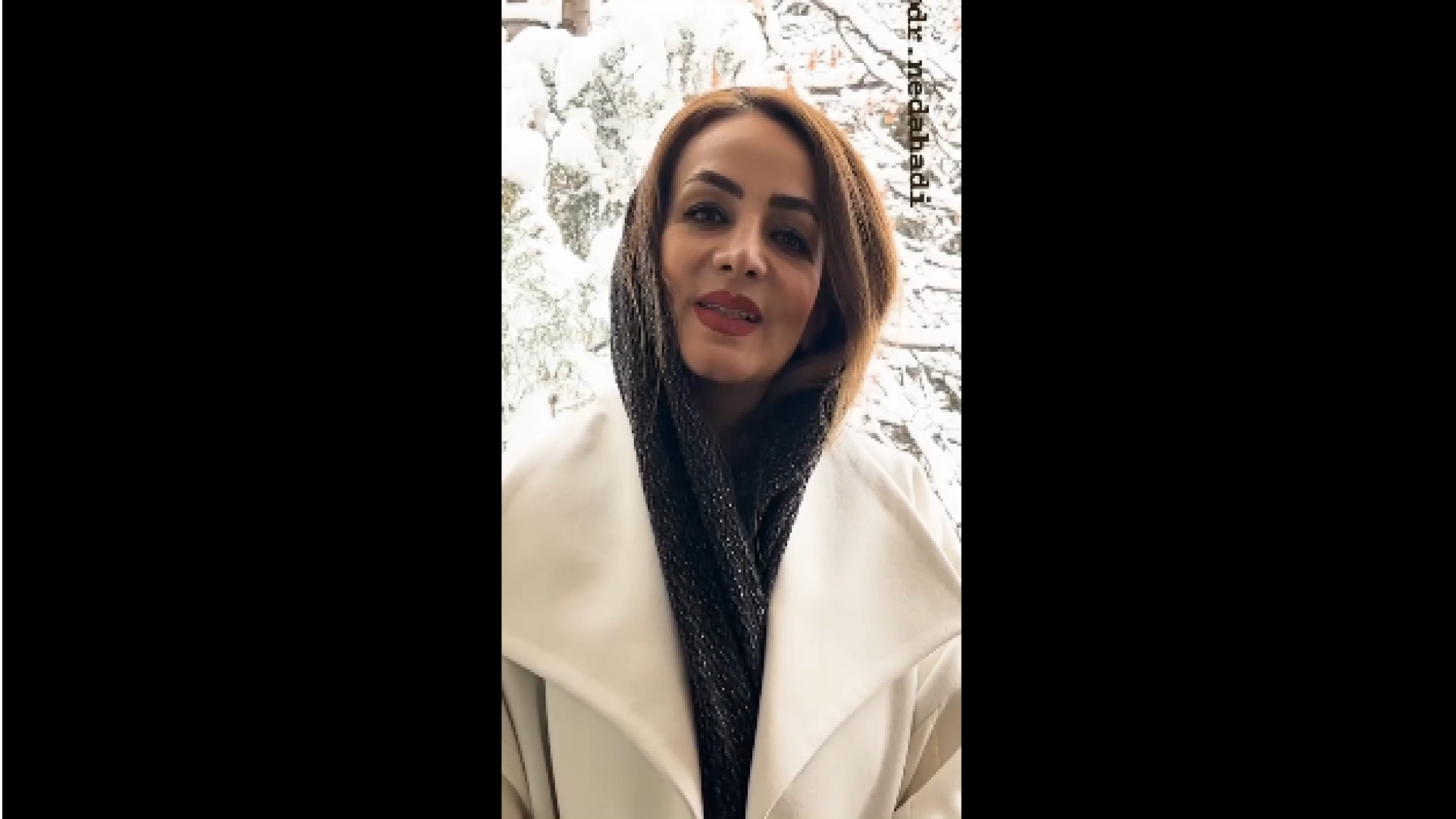 ایمپلنت برای افراد سیگاری دکتر ندا هادی-دندانپزشک زیبایی