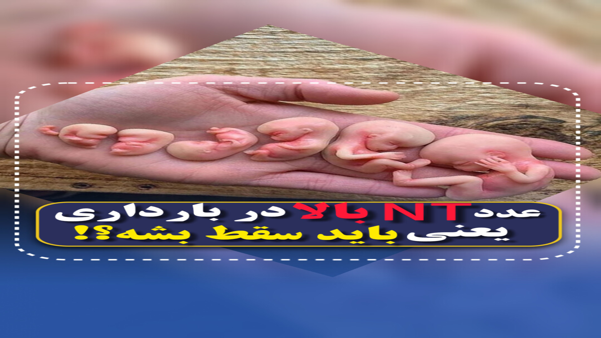 اگر nt در غربالگری بالا بود یعنی جنین مشکل داره؟ ۰۲۱۲۲۹۱۱۳۷۰ اینستاگرام