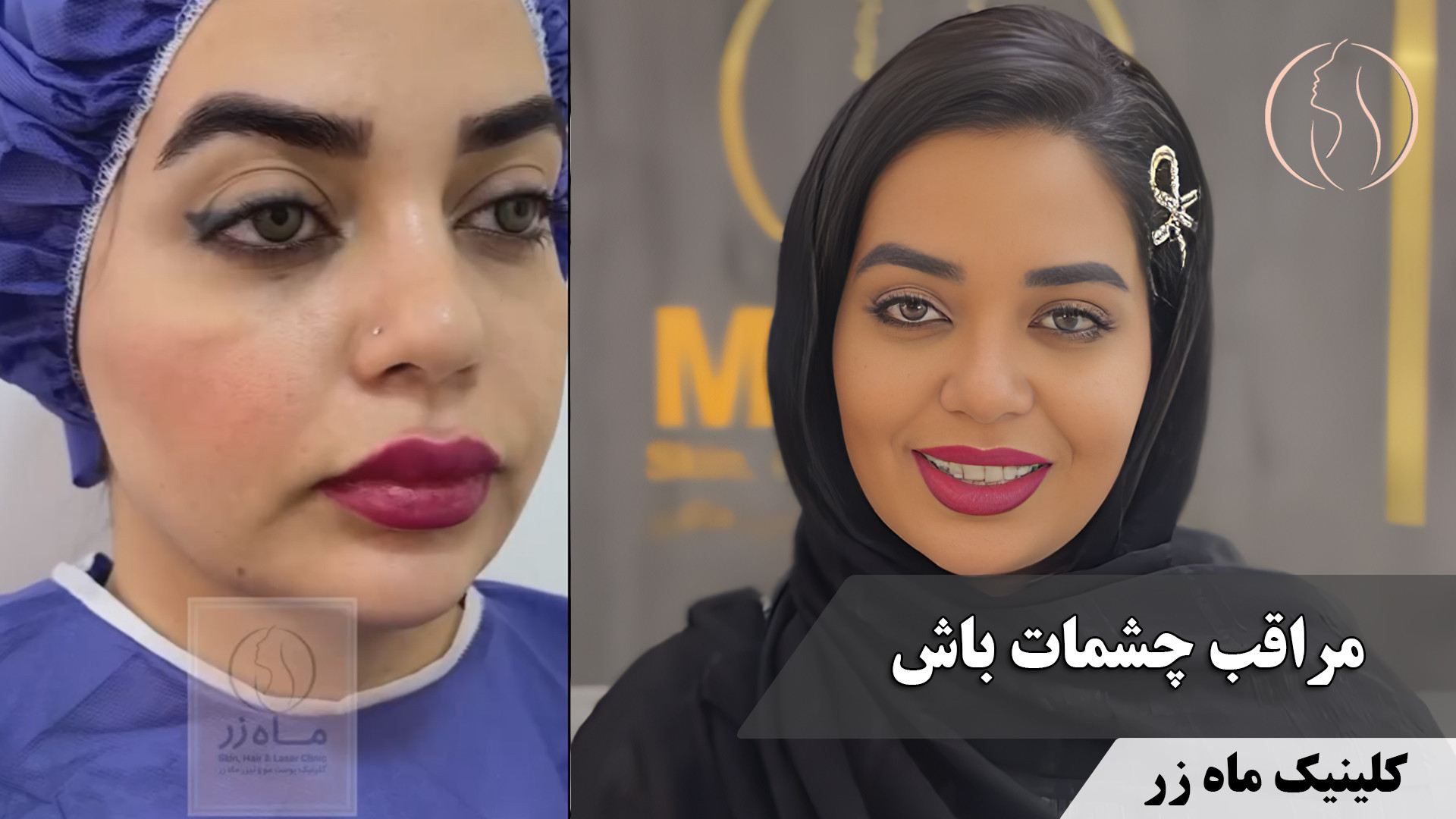 تخلیه ژل نامرغوب ( کلینیک زیبایی ماه زر ) Super Resolution Microscopy