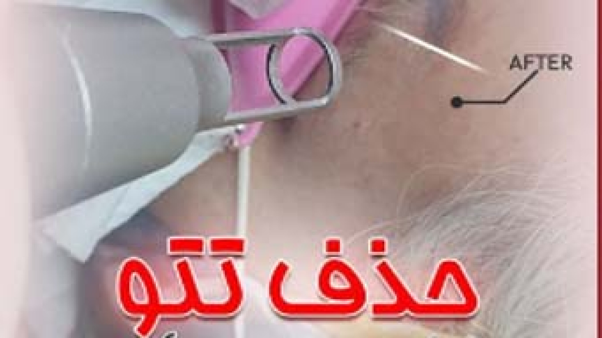 پاک کردن تتو با لیزر کیوسوئیچ | دکتر مریم بیکی دکتر مریم بیکی - پوست و مو و زیبایی اراک