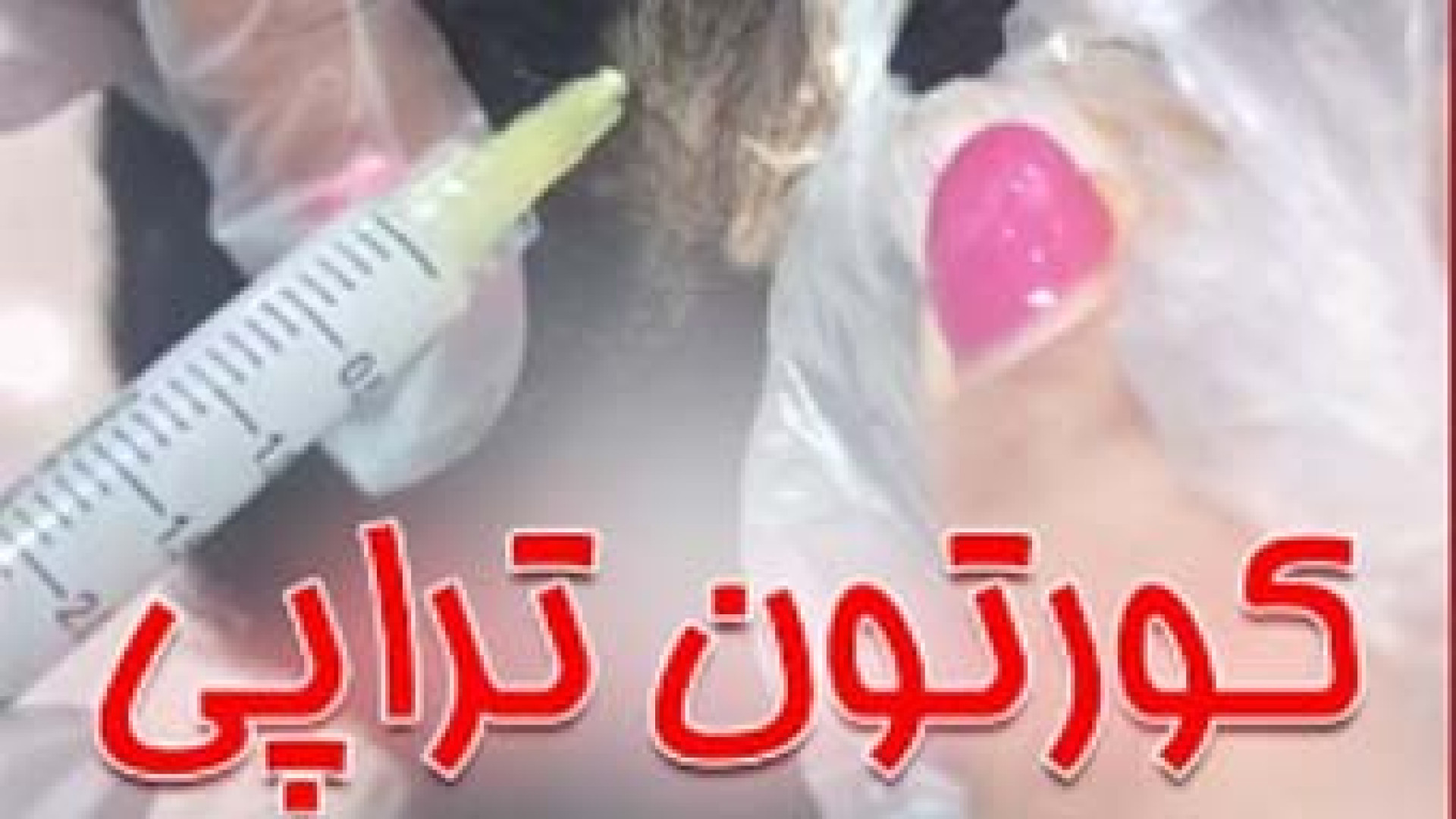 درمان ریزش سکه ای مو | دکتر مریم بیکی دکتر مریم بیکی - پوست و مو و زیبایی اراک