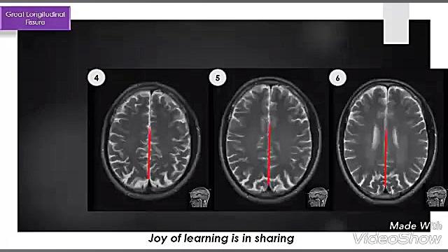 آناتومی مقطعی مغز در تصاویر MRI حلزون توربو