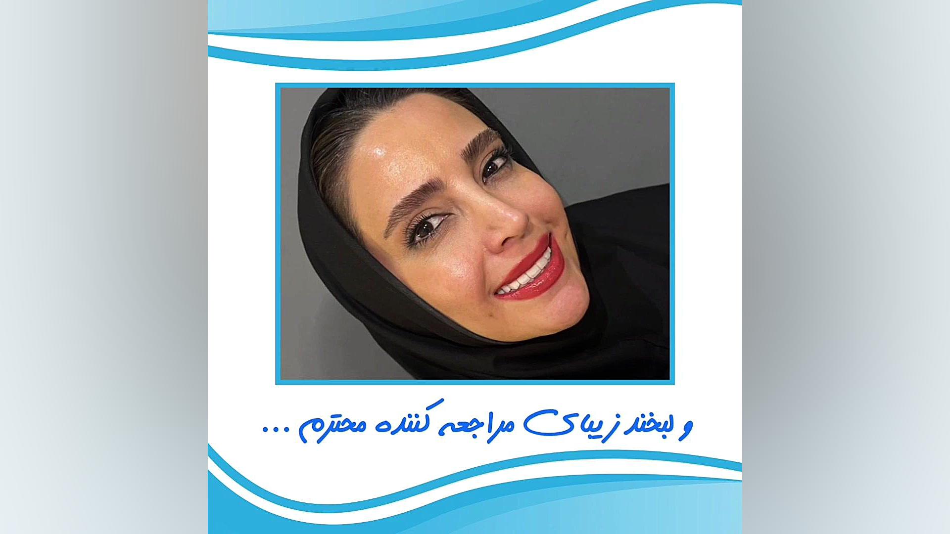 لیفت لثه ها با لیزر و لمینیت ایمکس فک بالا و پایین پتوز دوطرفه