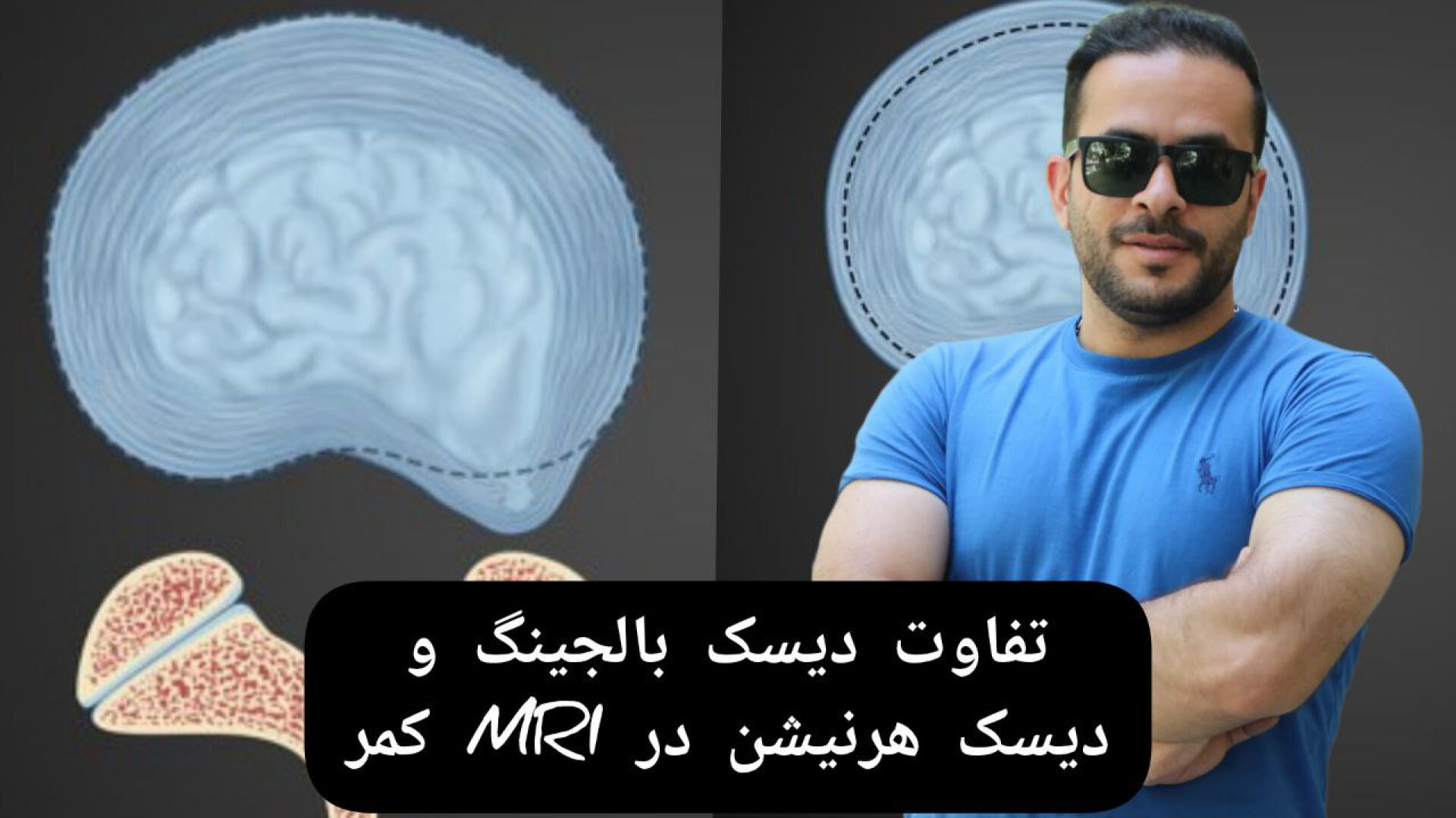 دیسک بالجینگ و دیسک هرنیشن در MRI کمر همایون شجریان