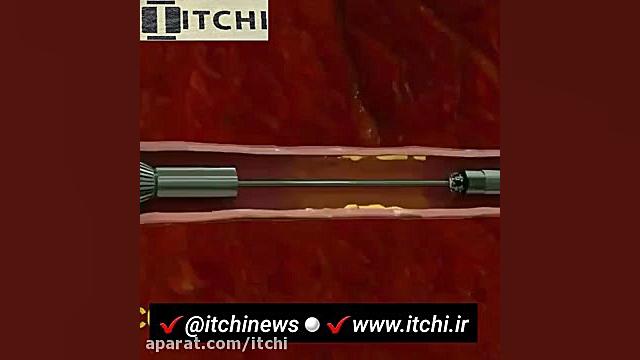 خداحافظی با سکته قلبی لیپوماتیک