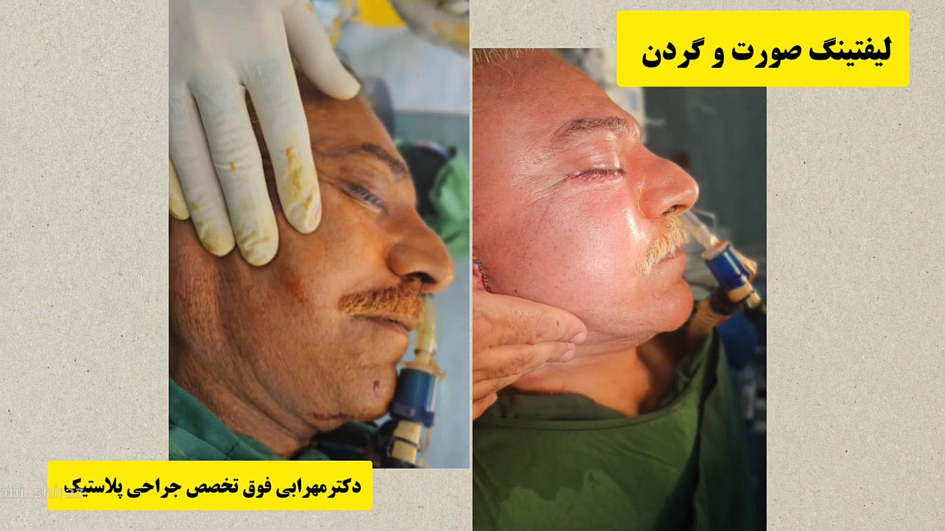 لیفت صورت و کشیدن پوست افتاده صورت لیفت گردن افتادگی صورت شیراز دکتر مهرابی دکتر محمد مهدی مهرابی جراح پلاستیک و زیبایی