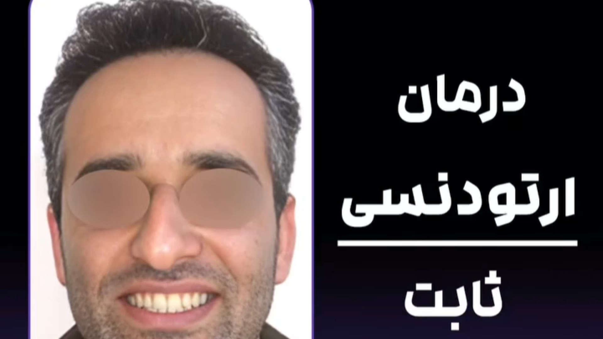 درمان ارتودنسی ثابت در بیمار 30 ساله دکتر ثریا یوسف نژاد متخصص ارتودنسی بابل