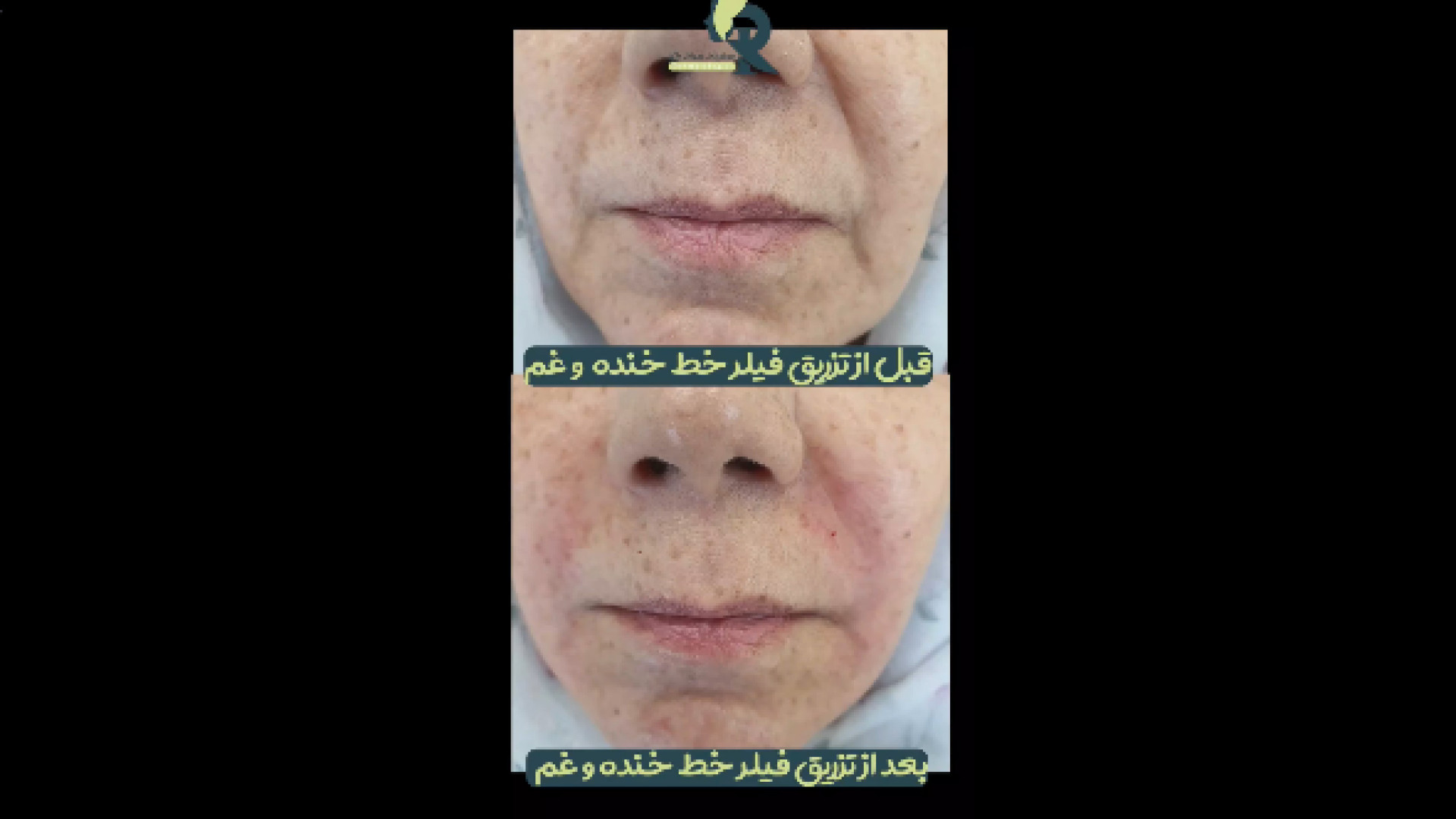 قبل و بعد تزریق فیلر خط خنده دکتر ایمان روغنی جراح و متخصص پوست و مو