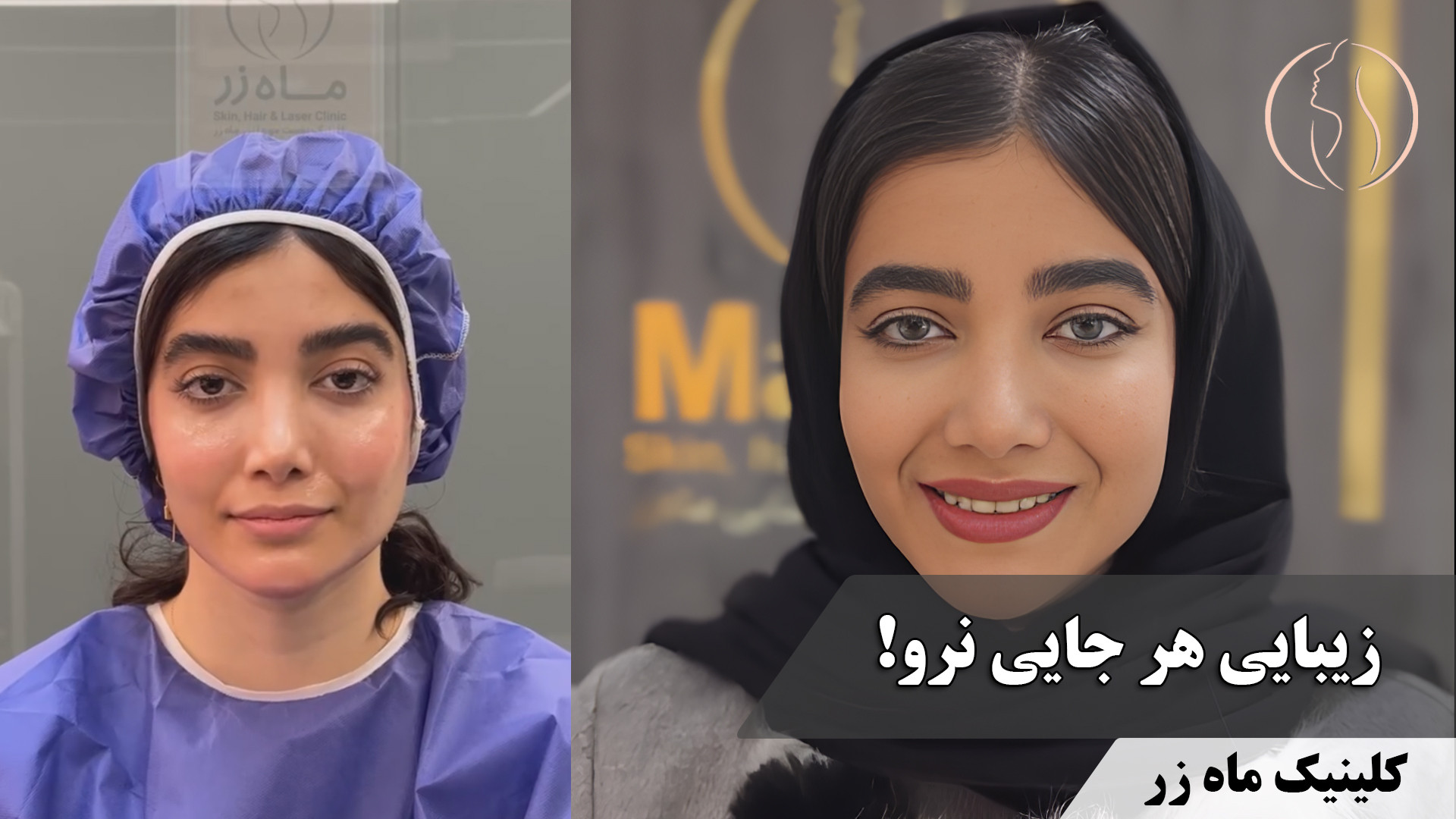 کپشن مهم ( کلینیک زیبایی ماه زر ) زاویه سازی صورت