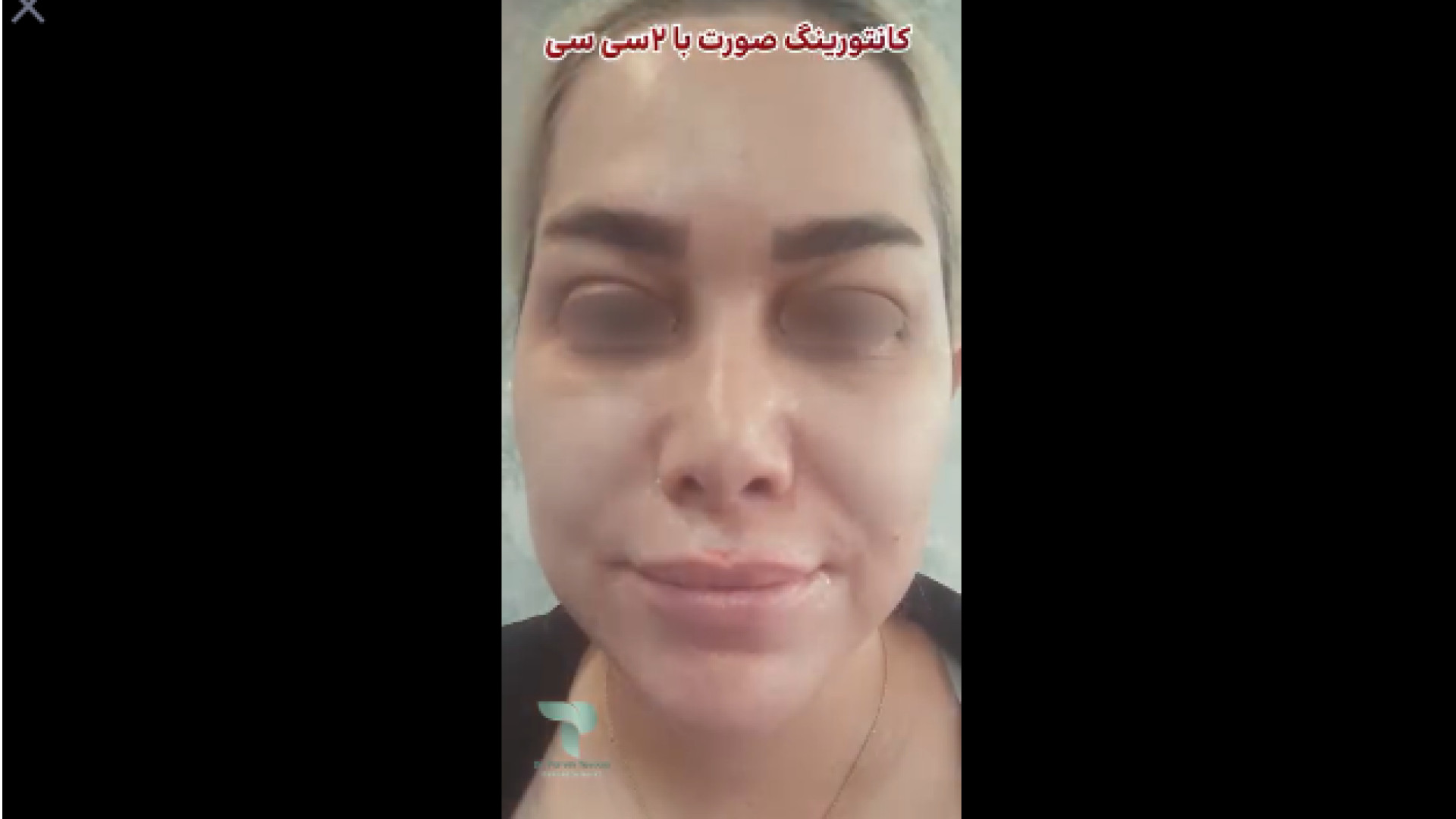 کانتورینگ صورت با ۲ سی سی ژل دکتر پروین طاوسی - متخصص پوست، مو و زیبایی