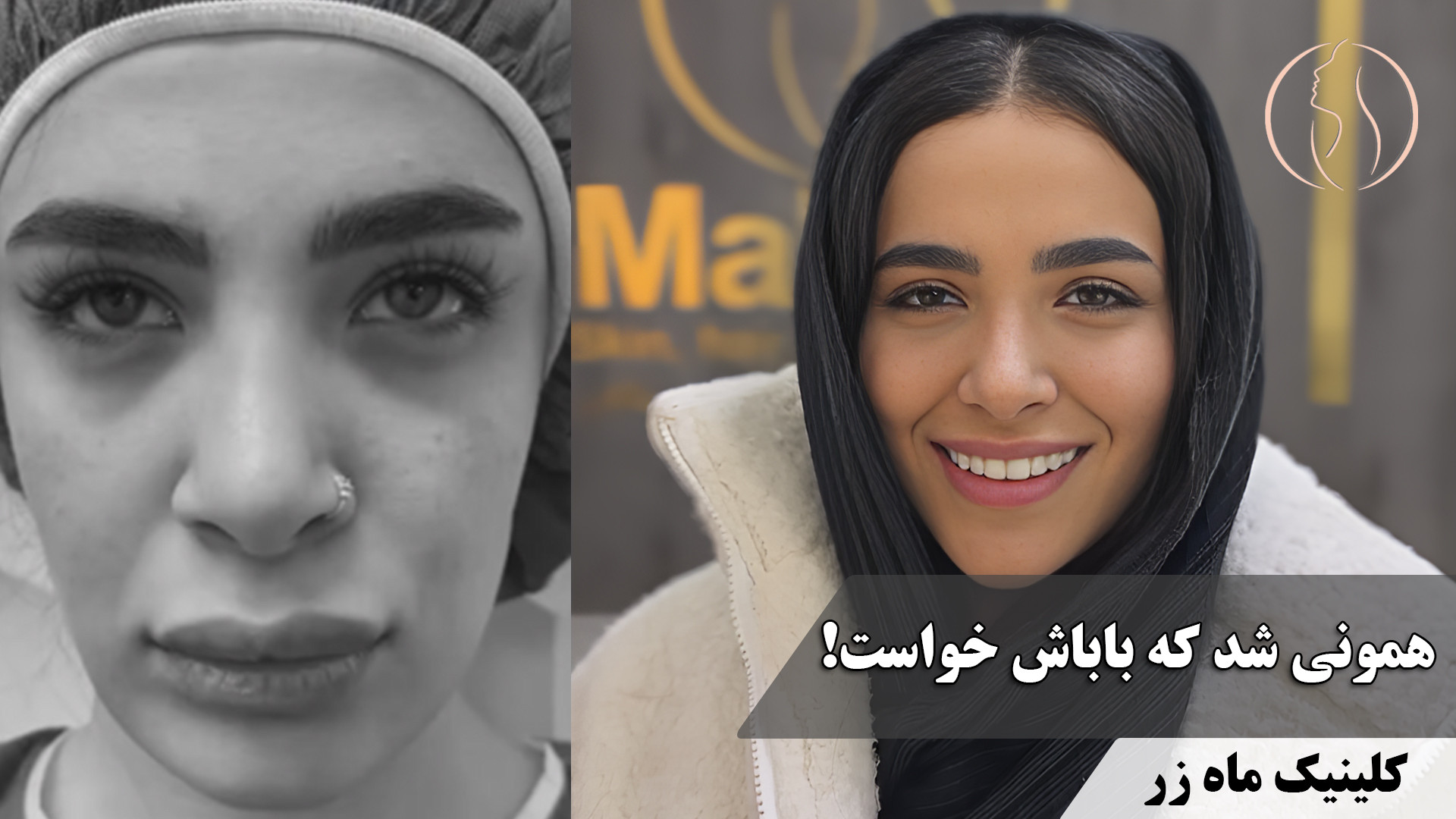 خوشحالیشون باعث خوشحالی منم شد ( کلینیک زیبایی ماه زر ) کربوکسی تراپی