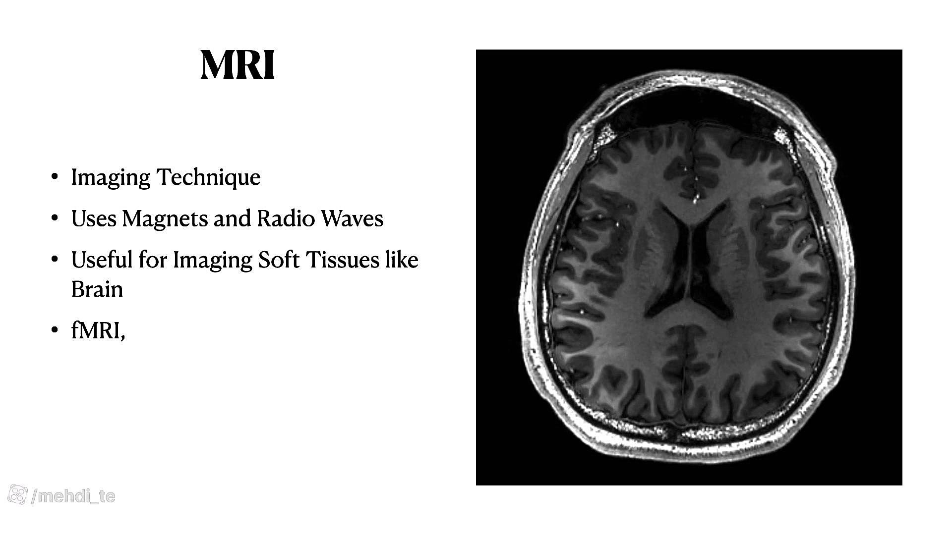 تحلیل شبکه مغزی با استفاده از شبکه‌های پیچیده پویا و تصاویر MRI دندان شیری