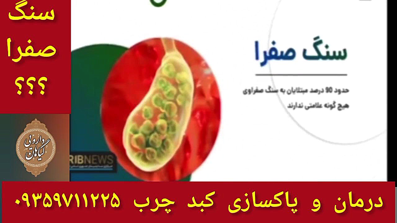 سنگ کیسه صفرا درمان و پاکسازی کبدچرب ۰۹۳۵۹۷۱۱۲۲۵ دکتر پوست