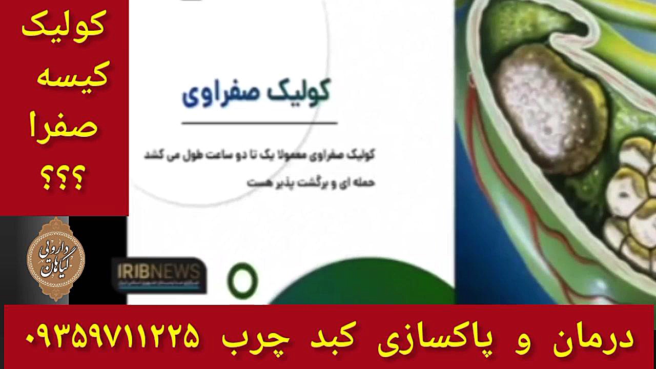 کولیک صفراوی درمان و پاکسازی کبدچرب ۰۹۳۵۹۷۱۱۲۲۵ جراحی زیبایی پلک