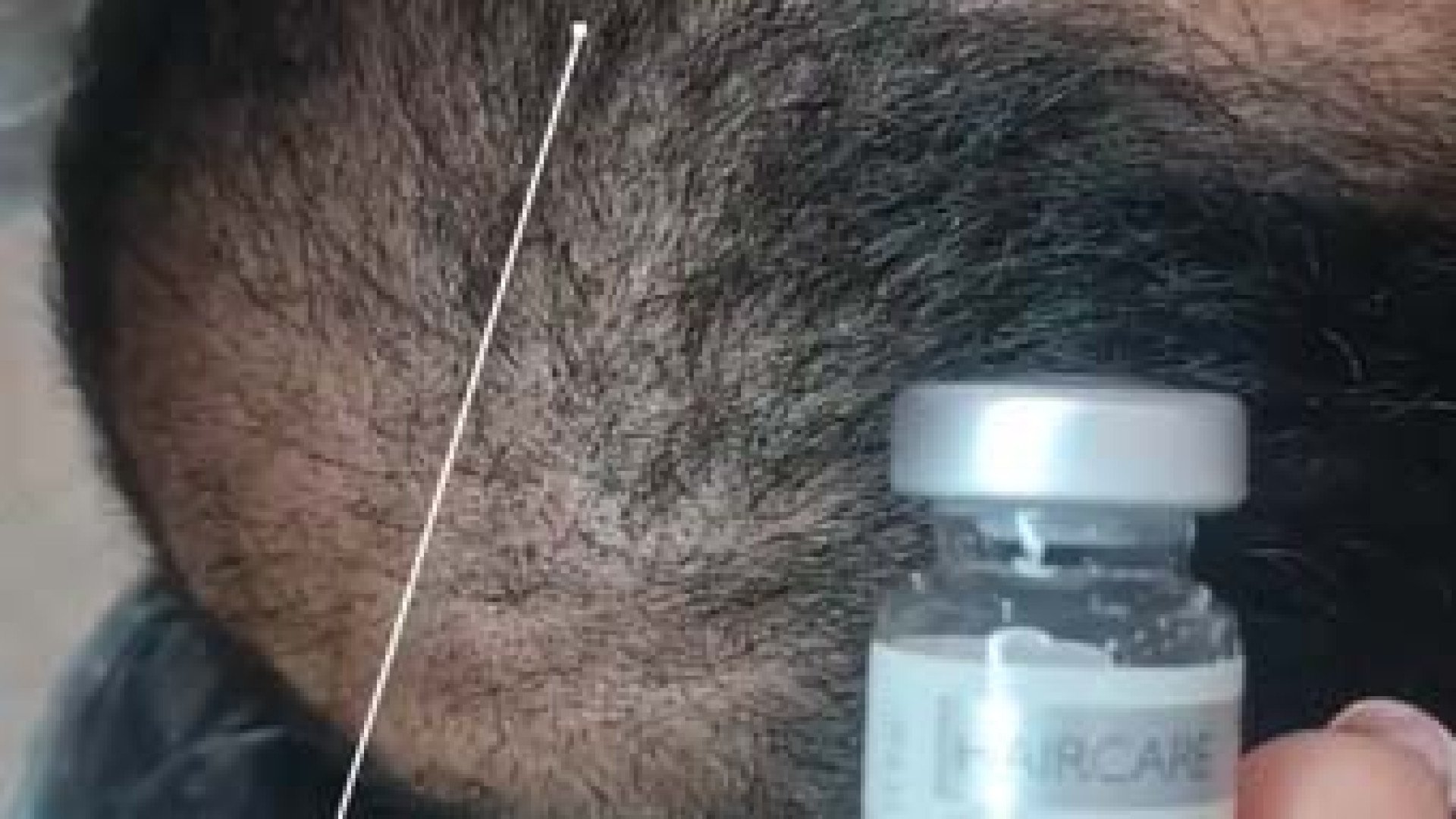مزوتراپی با مارک فرانسوی HairCare | دکتر مریم بیکی دکتر مریم بیکی - پوست و مو و زیبایی اراک