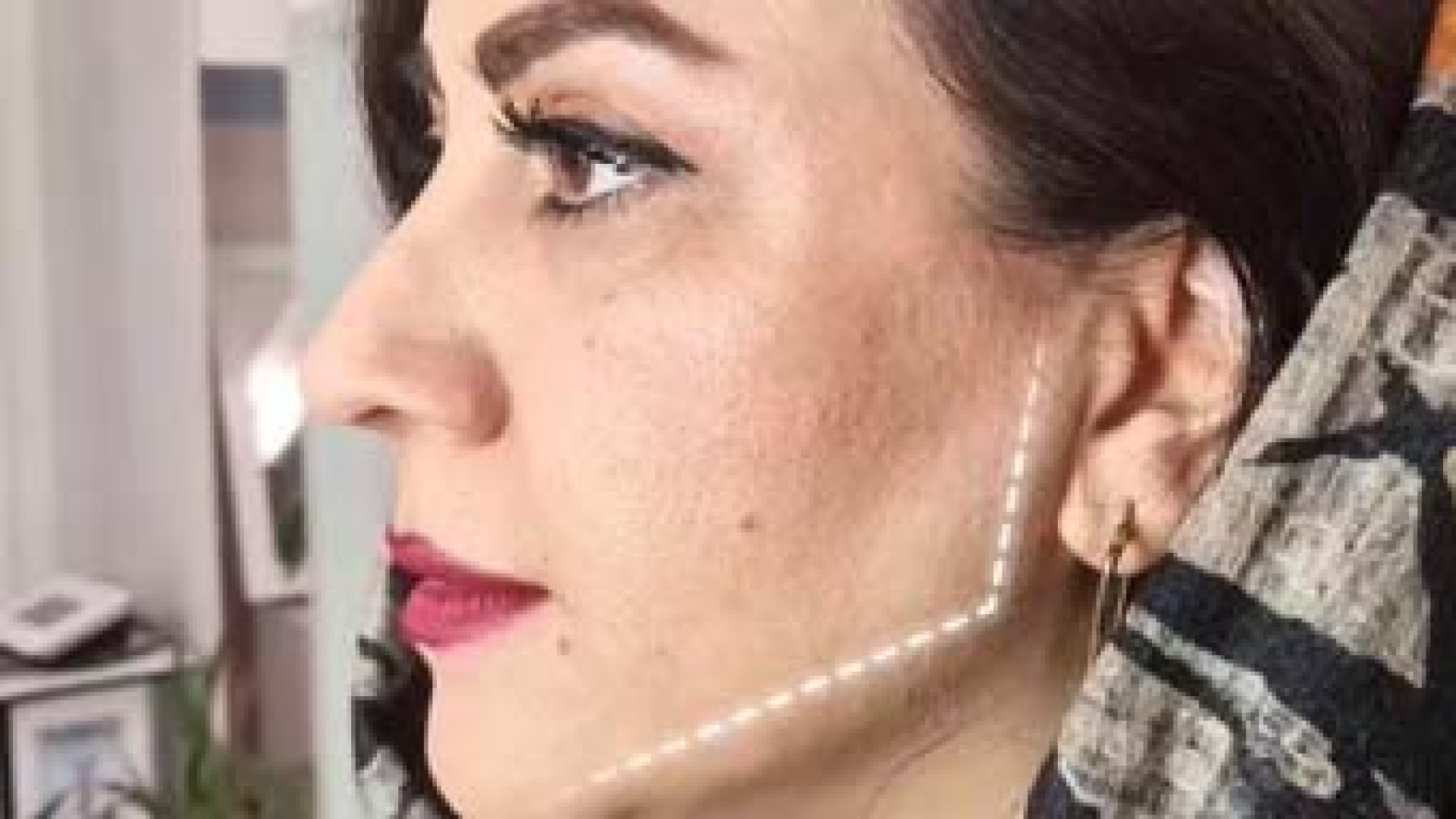 اصلاح زاویه فک | دکتر مریم بیکی دکتر مریم بیکی - پوست و مو و زیبایی اراک