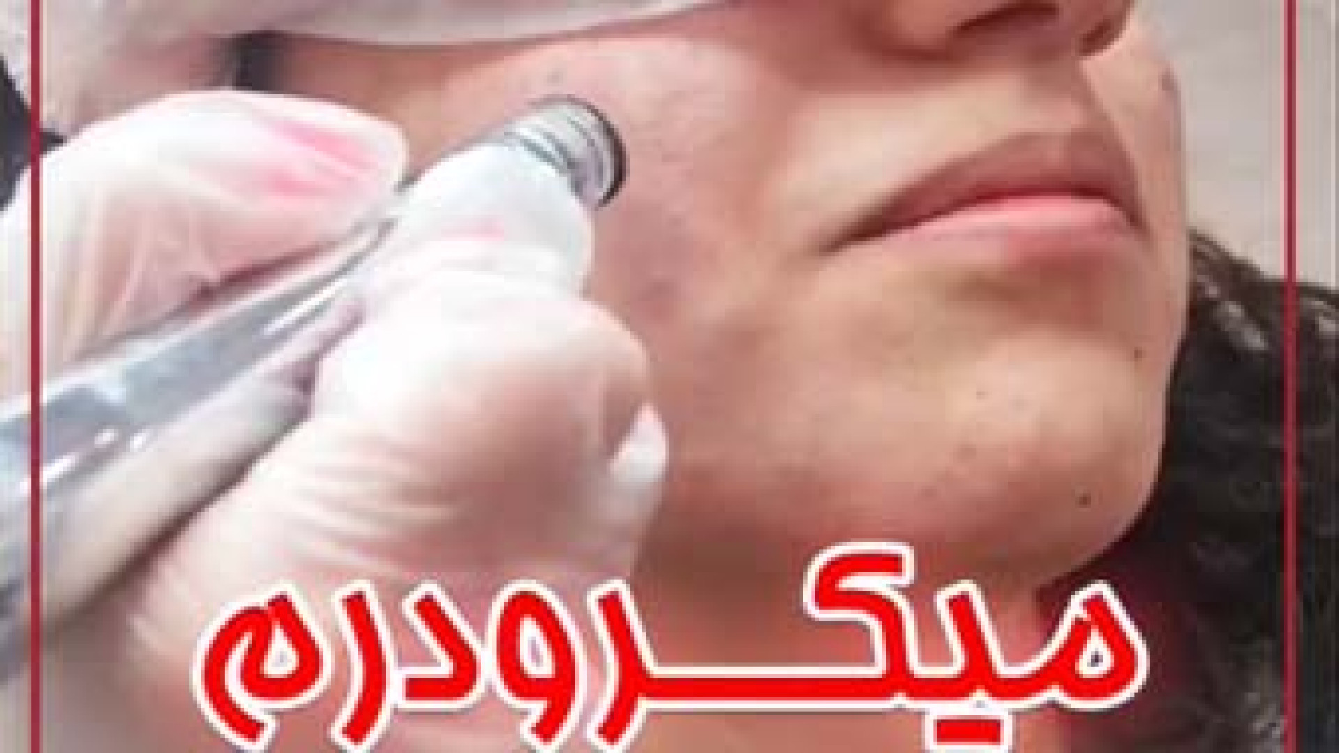 انجام میکرودرم توسط خانم دکتر مریم بیکی دکتر مریم بیکی - پوست و مو و زیبایی اراک