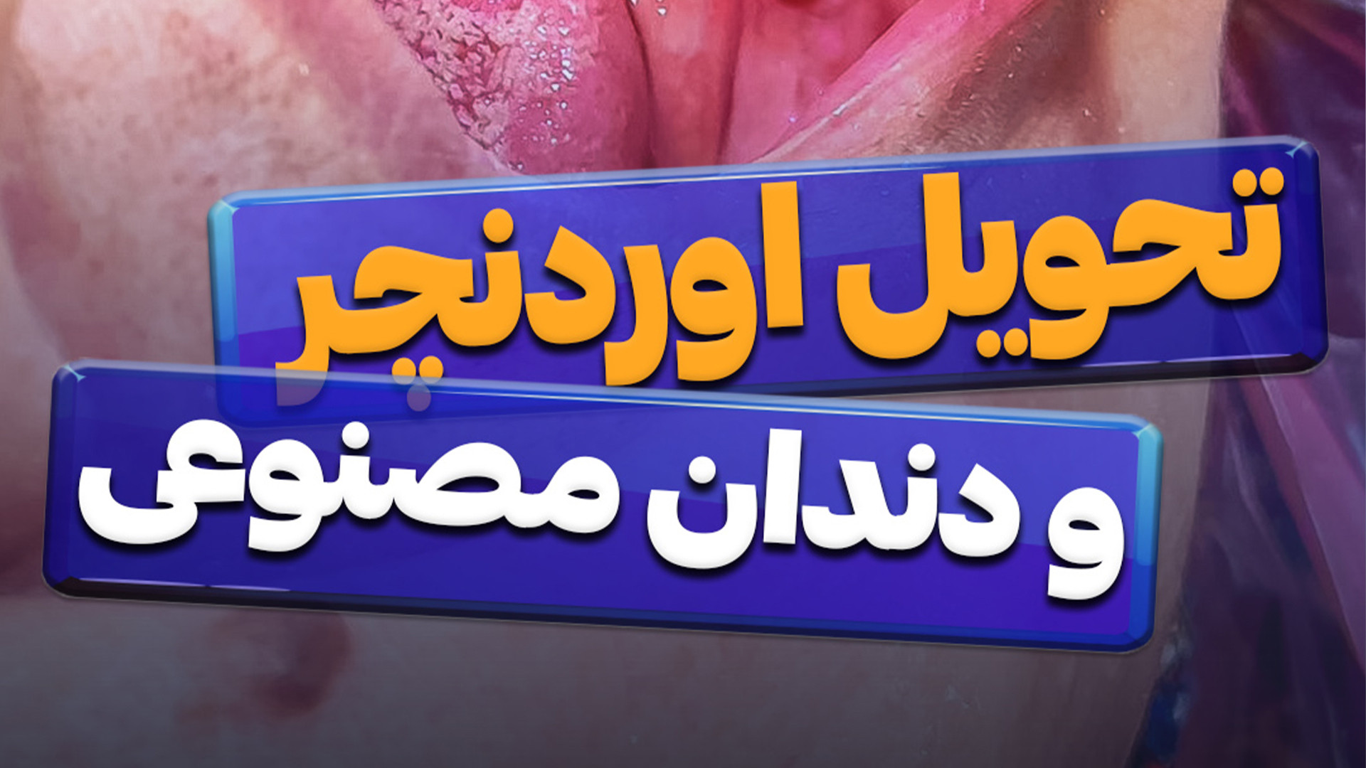 تحویل پروتز اوردنچر و دندان مصنوعی CUT&RUN