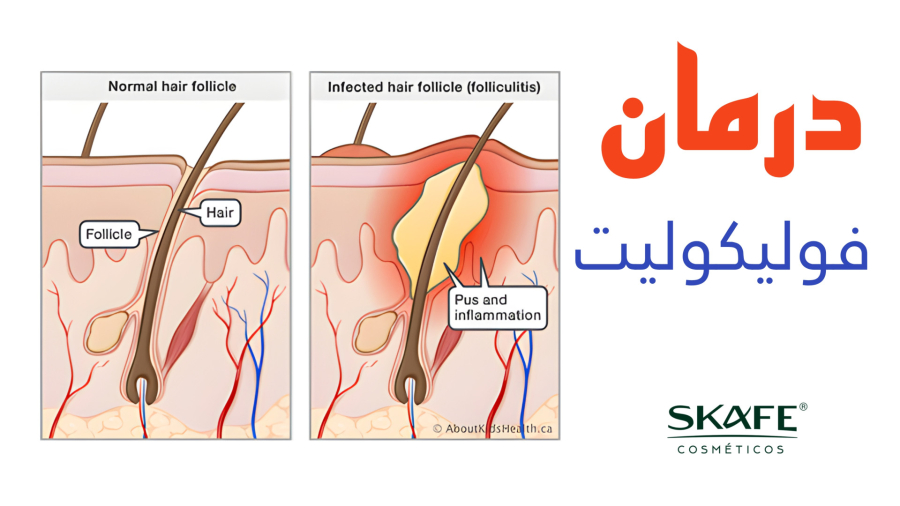 درمان بیماری فولیکولیت با محصولات اسکیف