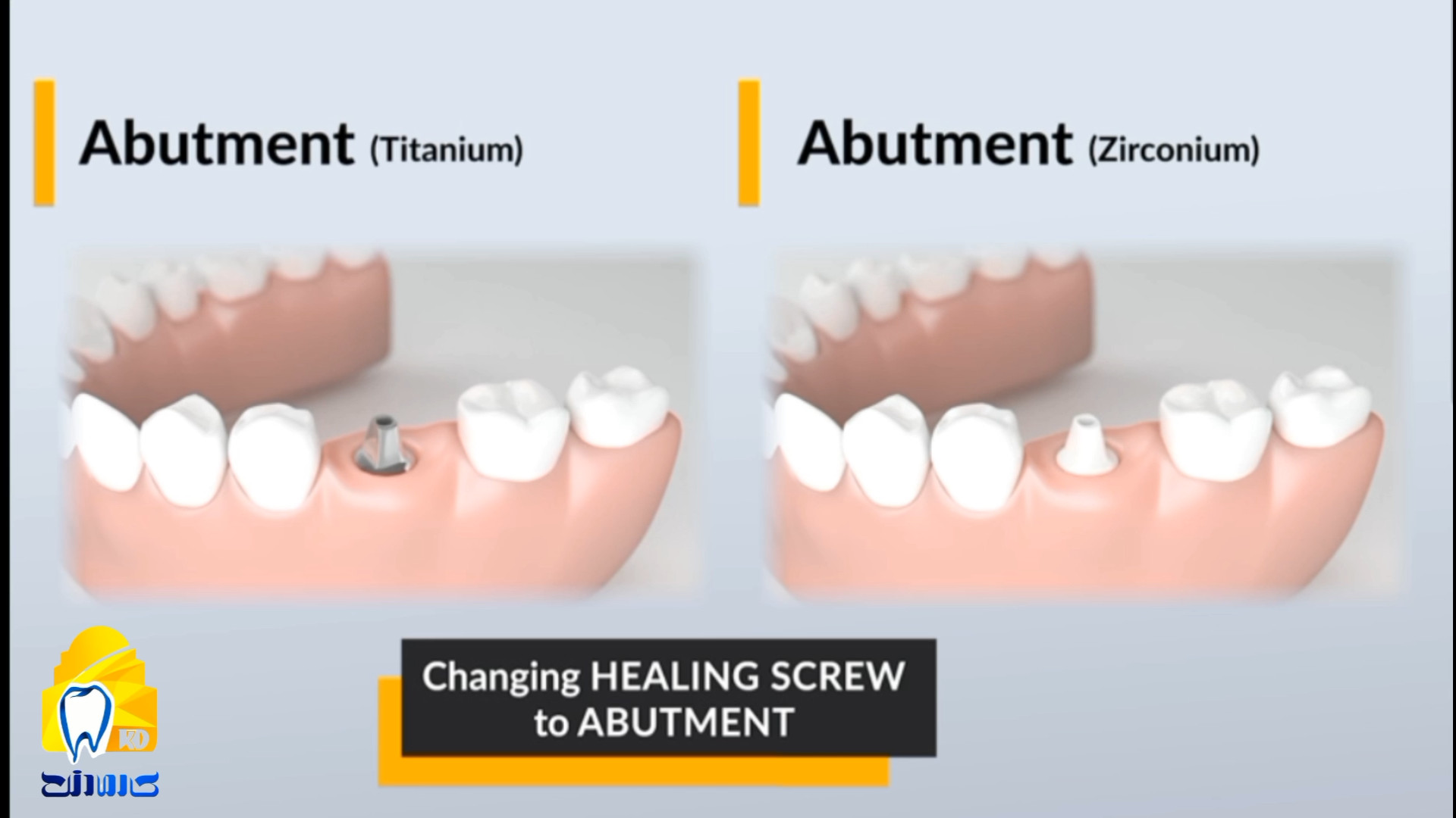 ایمپلنت و تفاوت اباتمنت تیتانیوم و زیرکونیوم کلینیک دندانپزشکی کارمادنت