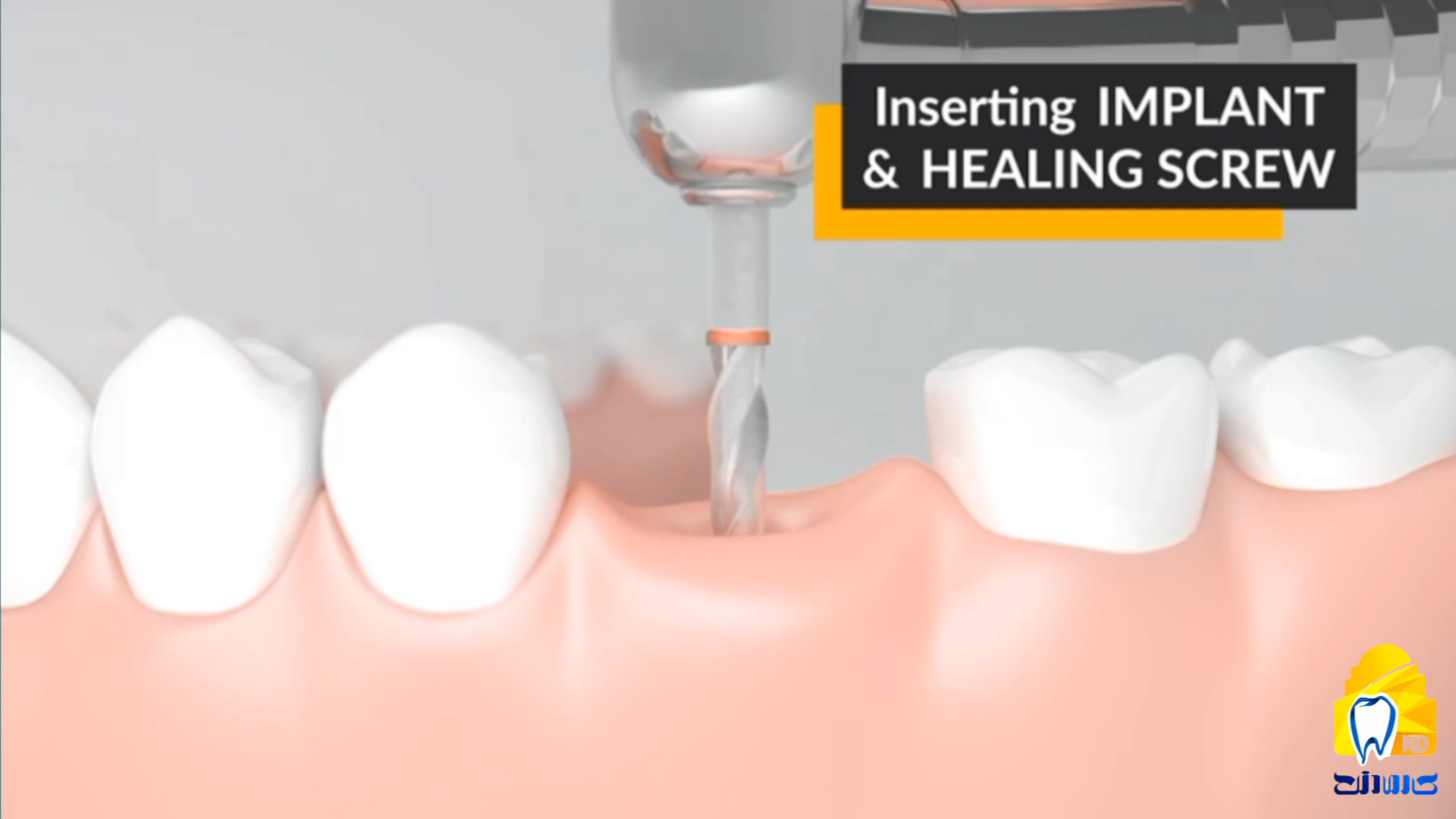 ایمپلنت و تفاوت اباتمنت تیتانیوم و زیرکونیوم1 کلینیک دندانپزشکی کارمادنت