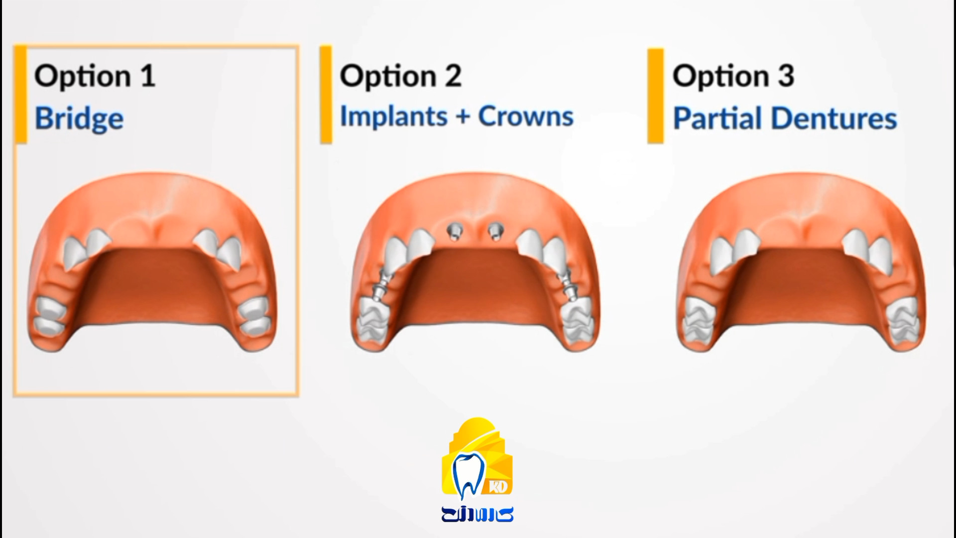تفاوت بریج، ایمپلنت و دنچر پارسیل برای 6 ناحیه بی دندانی کلینیک دندانپزشکی کارمادنت