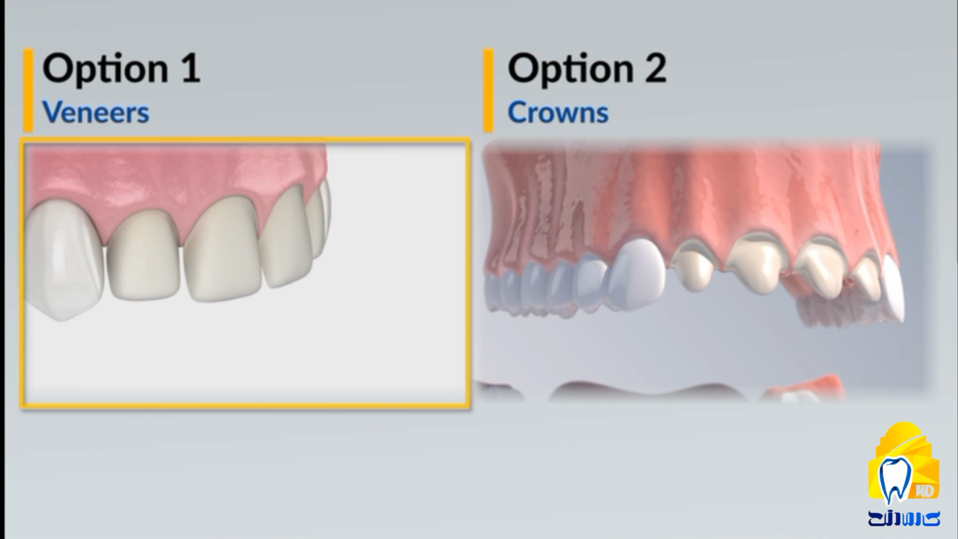 تفاوت ونیر سرامیکی(لمینیت) با روکش کلینیک دندانپزشکی کارمادنت