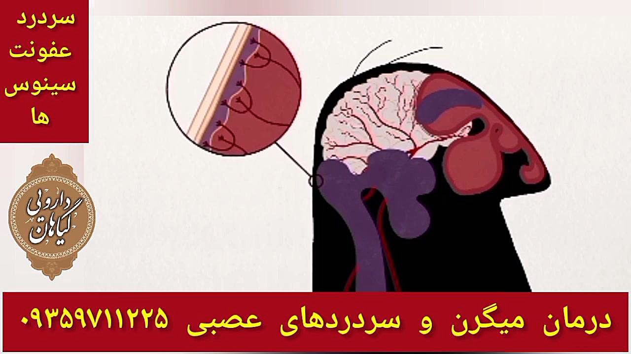سردرد سینوزیت درمان میگرن و سردرد عصبی ۰۹۳۵۹۷۱۱۲۲۵ جواد عزتی