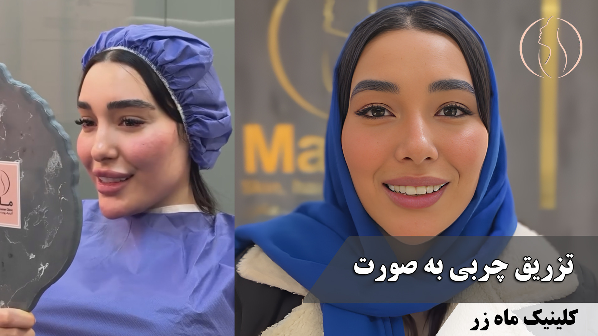 فکر نمی‌کردم آخرش اینجوری بشه ( کلینیک زیبایی ماه زر ) HiChIP