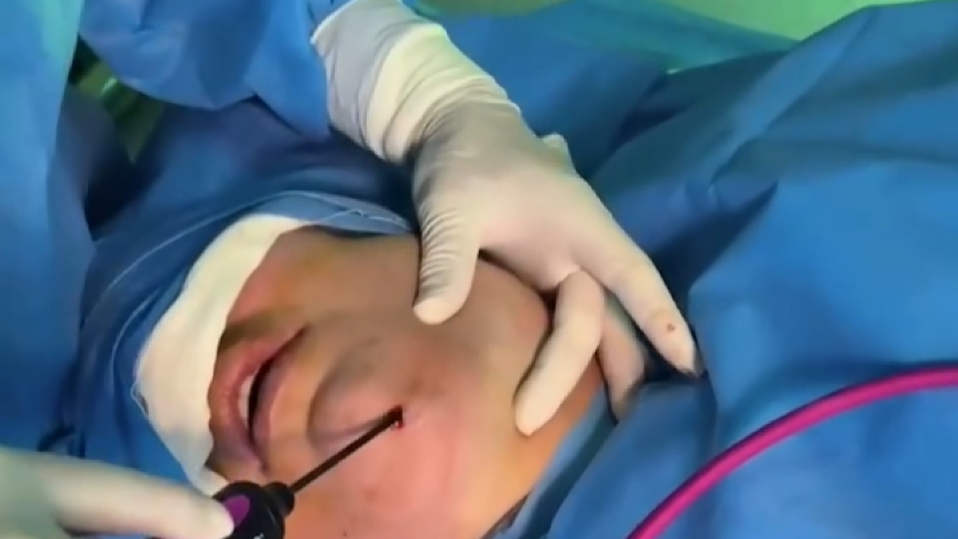 رنووین بعد از لیپوساکشن دکتر حسین پناه