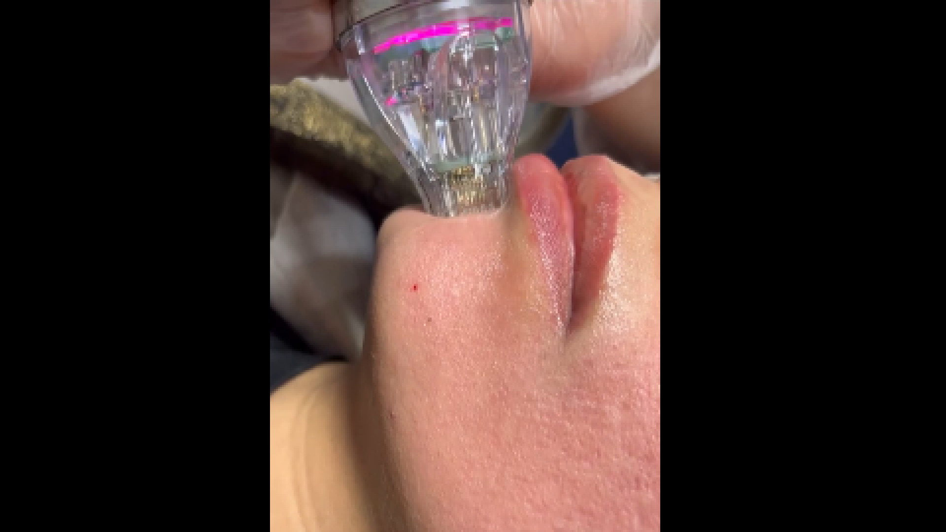 کاربرد آر اف چیست؟ دکتر صدیقه نائیجی | متخصص پوست و مو در قم