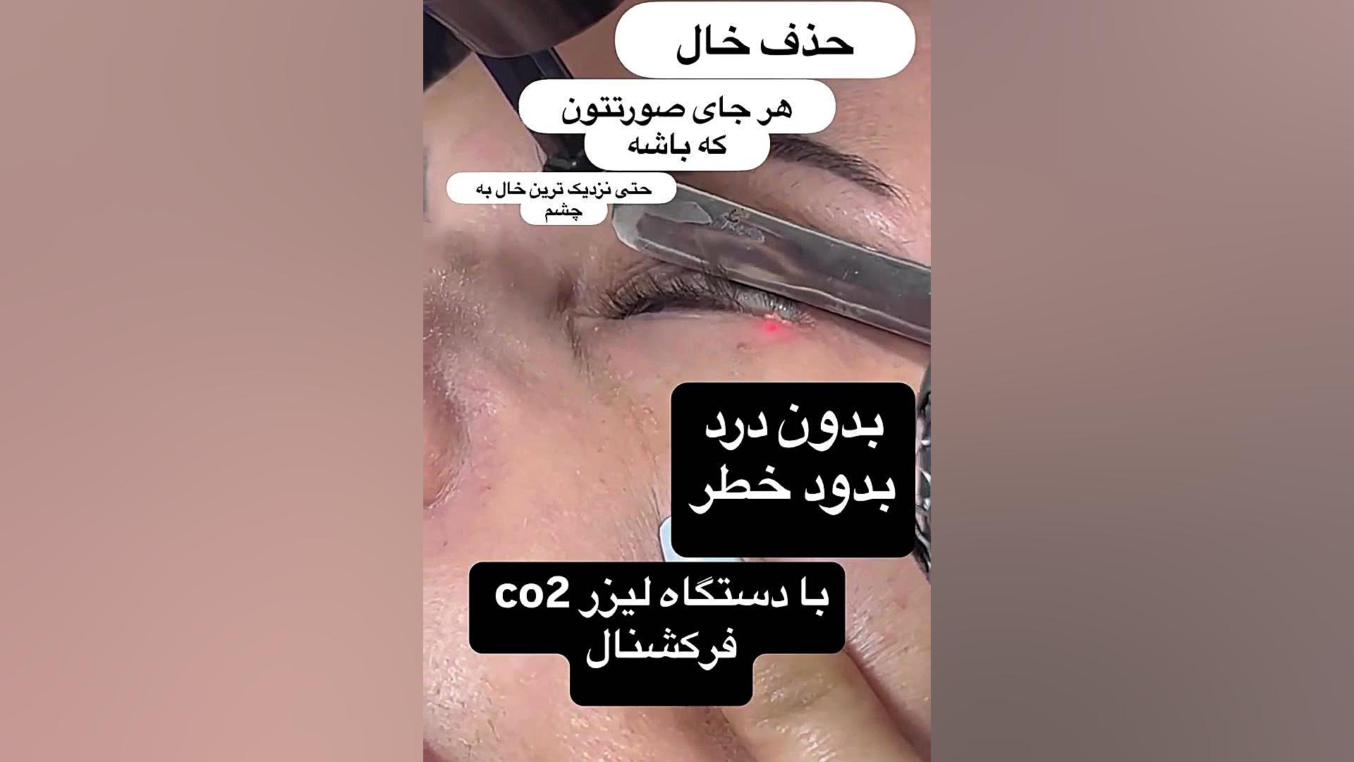حذف خال بدون درد پزشکی شخصی‌سازی‌شده سطح یاخته‌ای