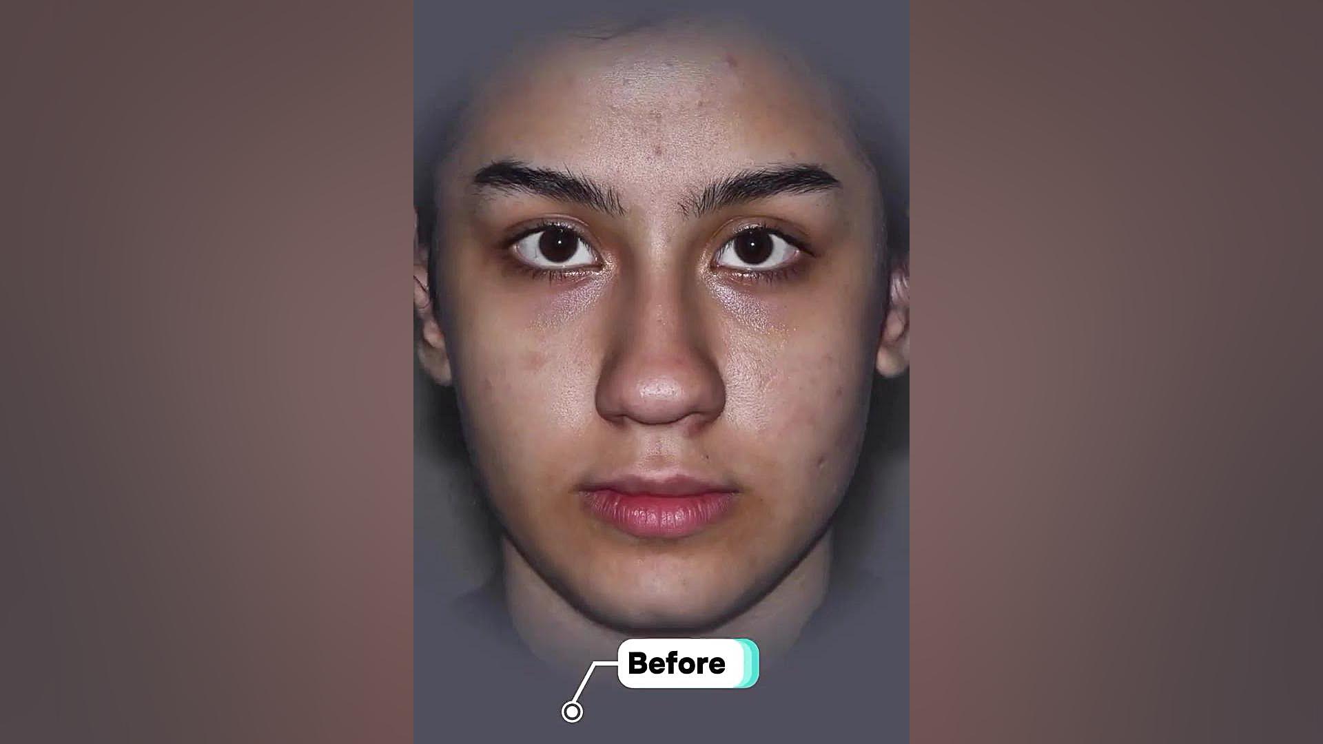 جراحی شیک و نیمه فانتزی توسط دکتر علی شفیعی دکتر علی شفیعی رونیزی | بهترین جراح بینی تهران