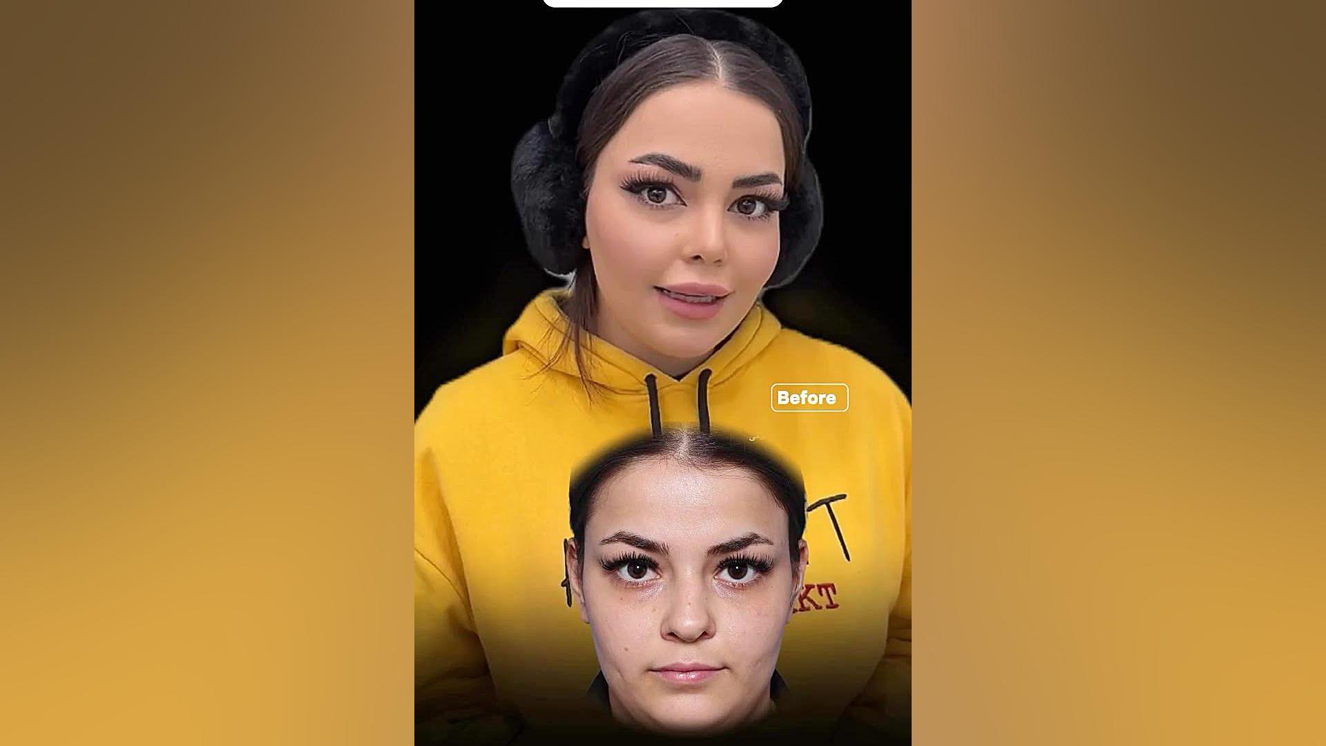 عمل بینی عروسکی توسط دکتر شفیعی دکتر علی شفیعی رونیزی | بهترین جراح بینی تهران