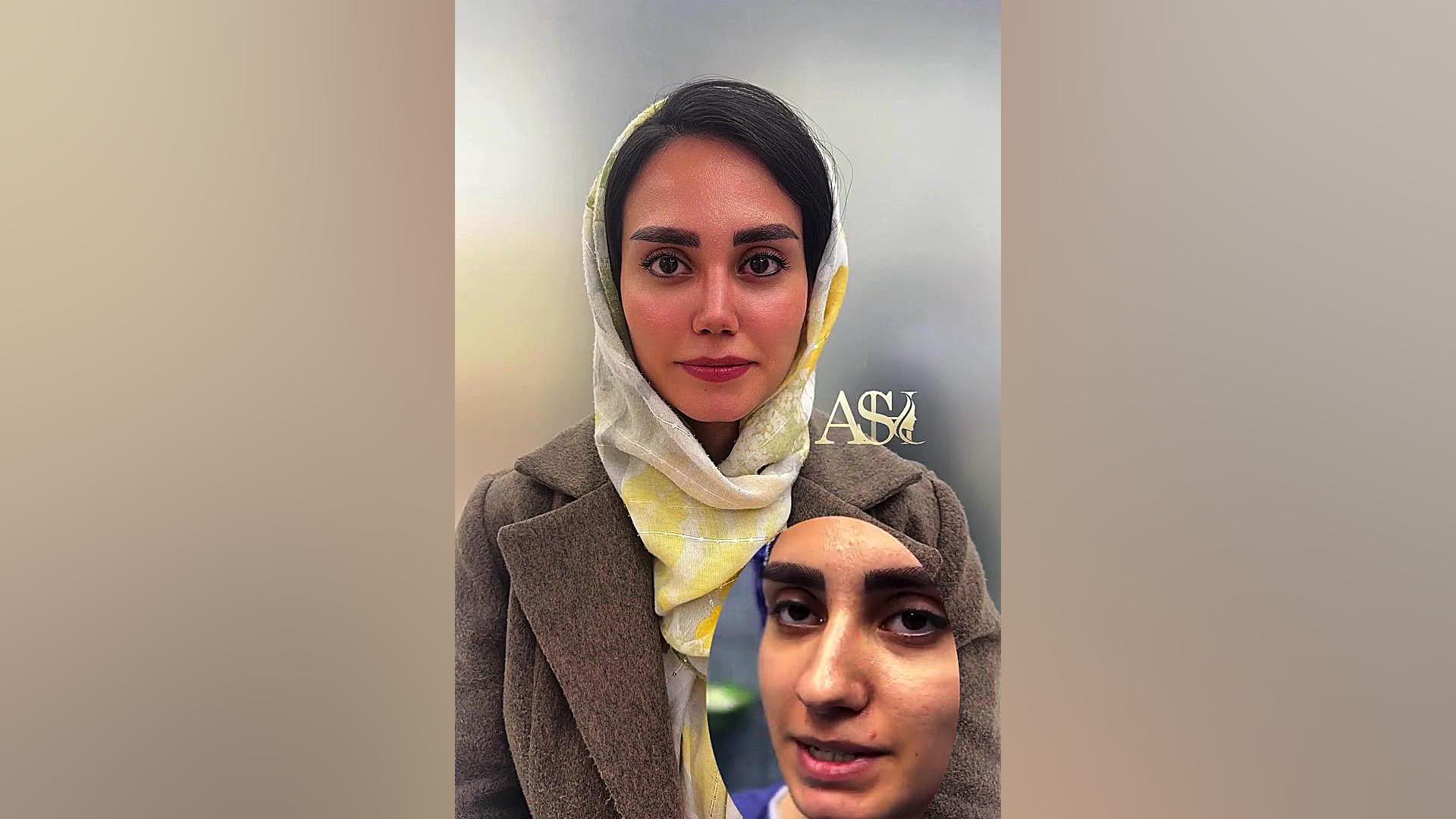 عمل بینی توسط جراح ماهر در تهران دکتر علی شفیعی رونیزی | بهترین جراح بینی تهران