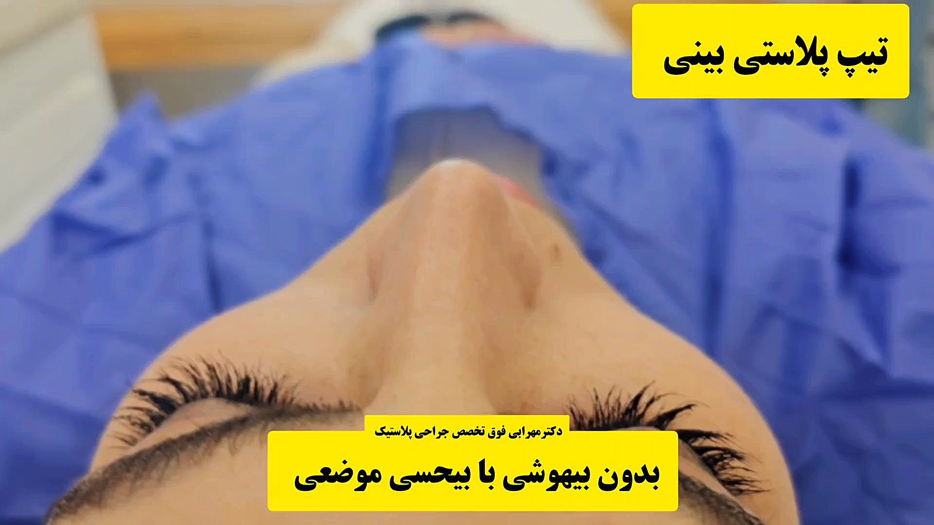 تیپ پلاستی بینی بدون بیهوشی با بیحسی موضعی دکتر مهرابی شیراز دکتر محمد مهدی مهرابی جراح پلاستیک و زیبایی