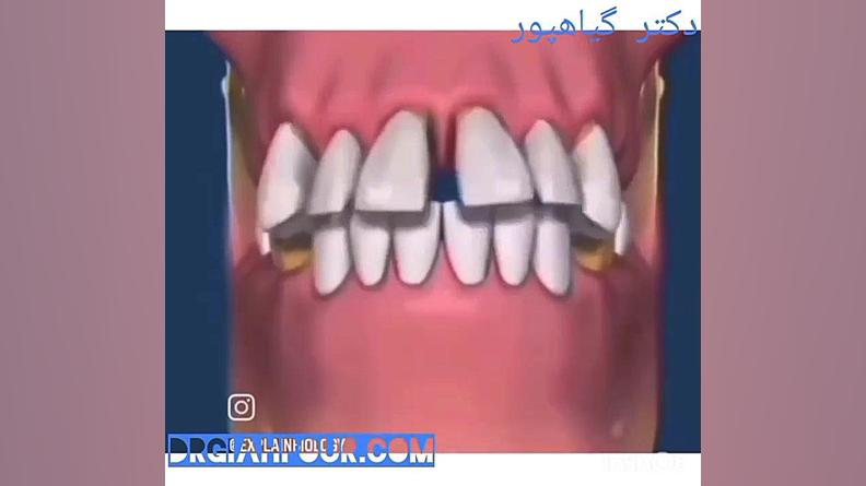 تخریب دندان های سالم به دلیل ترمیم نکردن دندان های از دست رفته به روایت تصویر . دکتر اللهیار گیاهپور