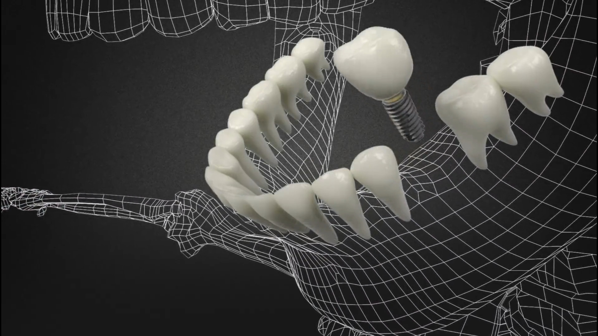 ایمپلنت دنتیس Dentis SQ برداشتن خال
