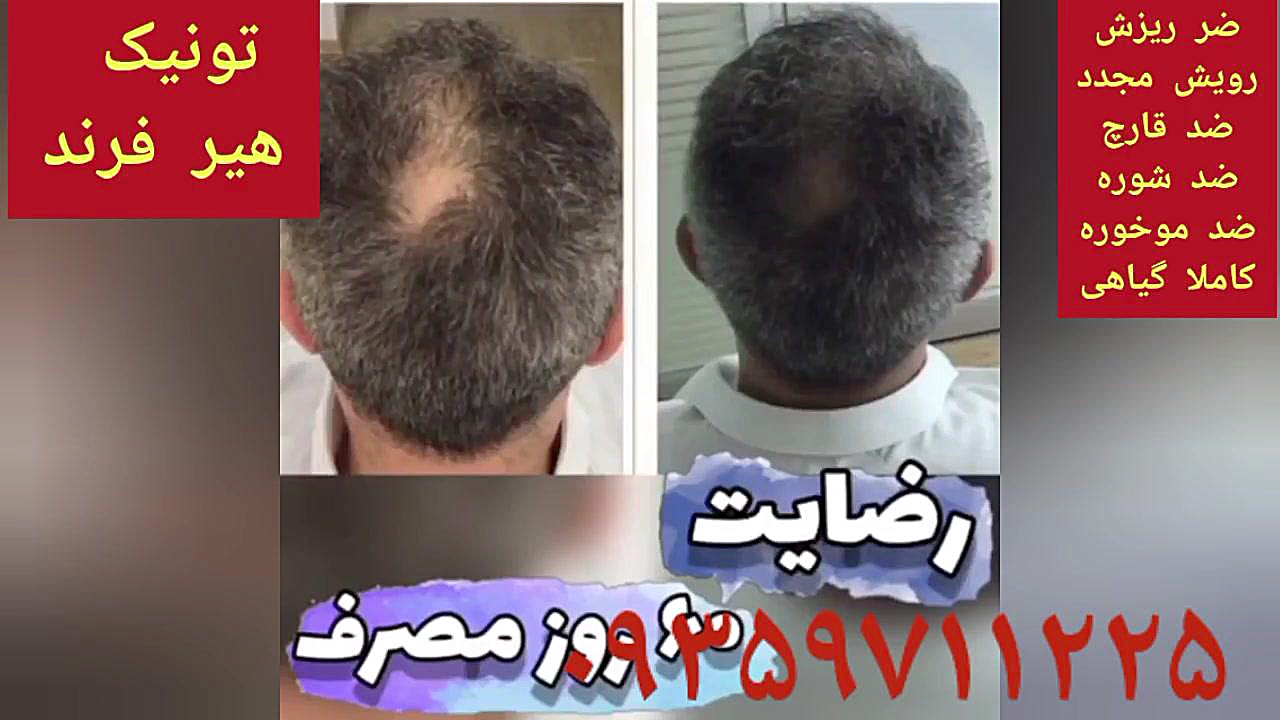 تجربه درمان ریزش مو با تونیک هیرفرند ۰۹۳۵۹۷۱۱۱۲۲۵ GRO-Seq