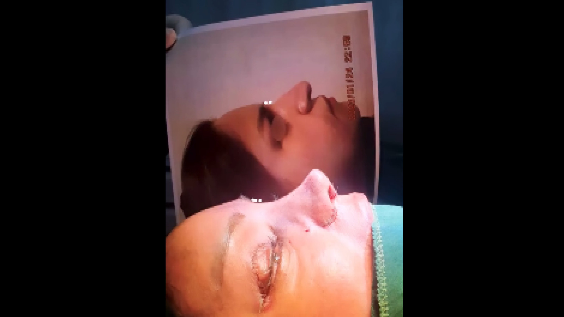 عمل بینی توسط دکتر محمودرضا اصحاب یمین دکتر محمودرضا اصحاب یمین - فوق تخصص پلاستیک